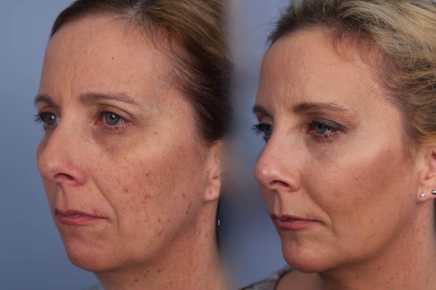 Fractional CO2 Laser Before and After Gallery – Photo 39