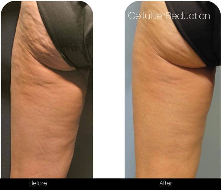 Cellulite Reduction Before and After Gallery – Photo 1
