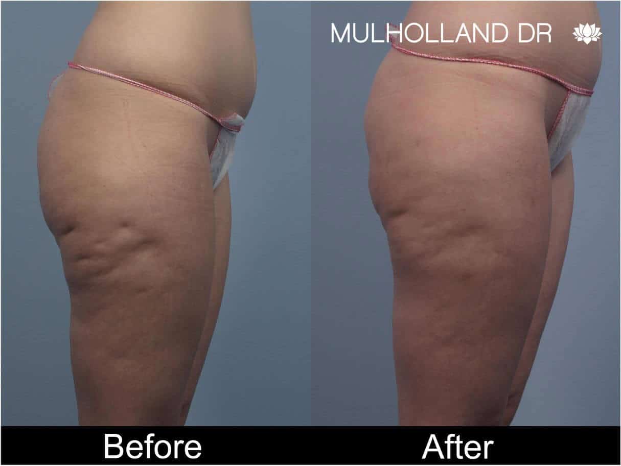 Cellulite Reduction Before and After Gallery – Photo 46