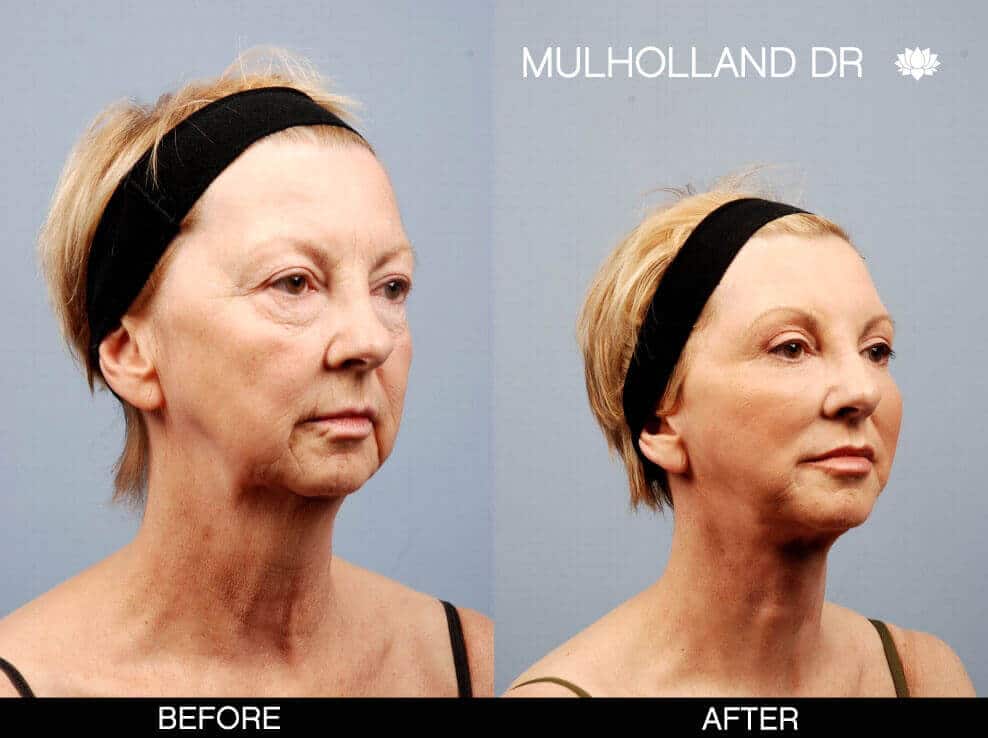 FaceTite Before and After Gallery – Photo 25