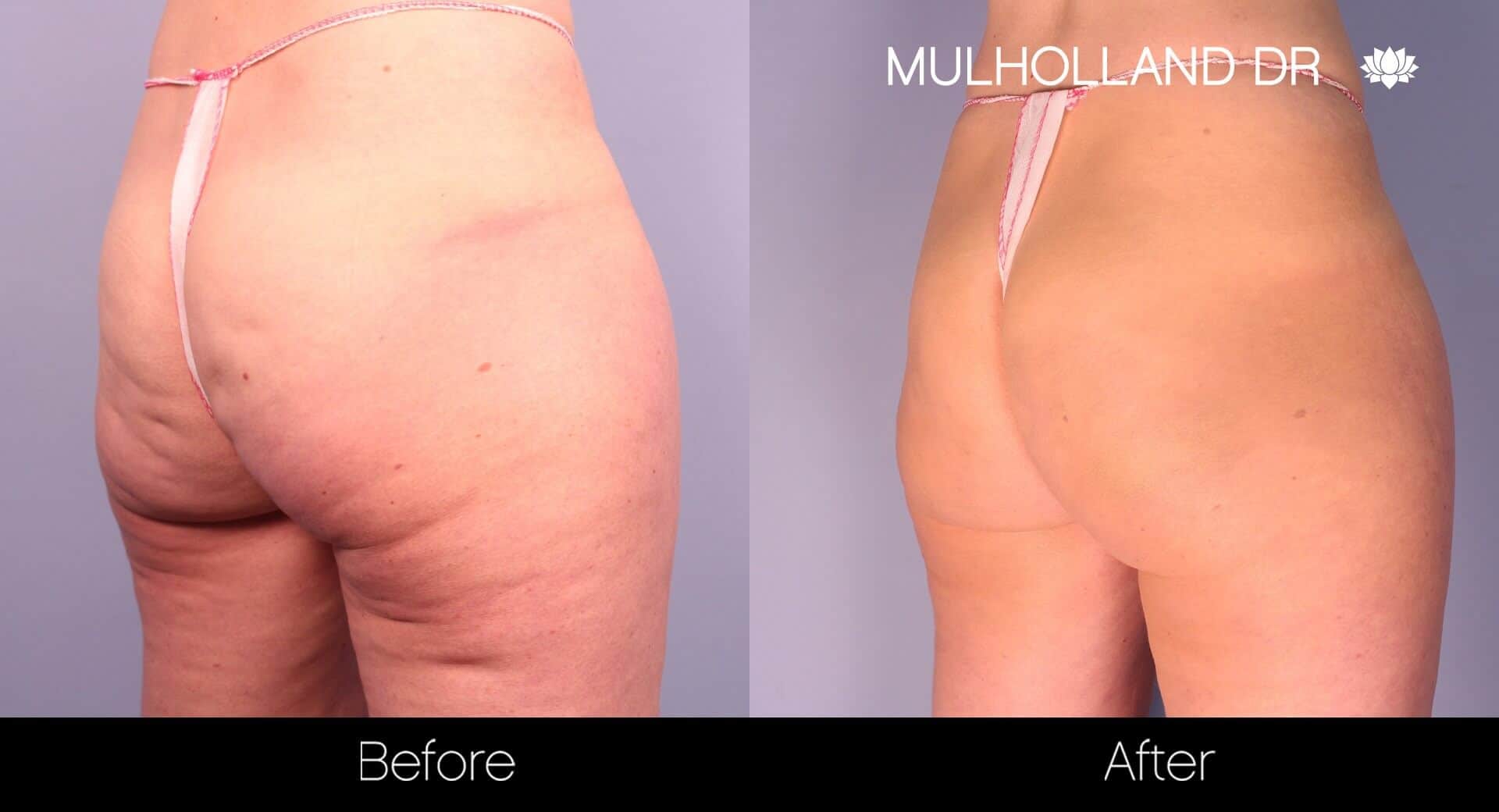 Cellfina Cellulite Treatment - Before and After Gallery – Photo 4