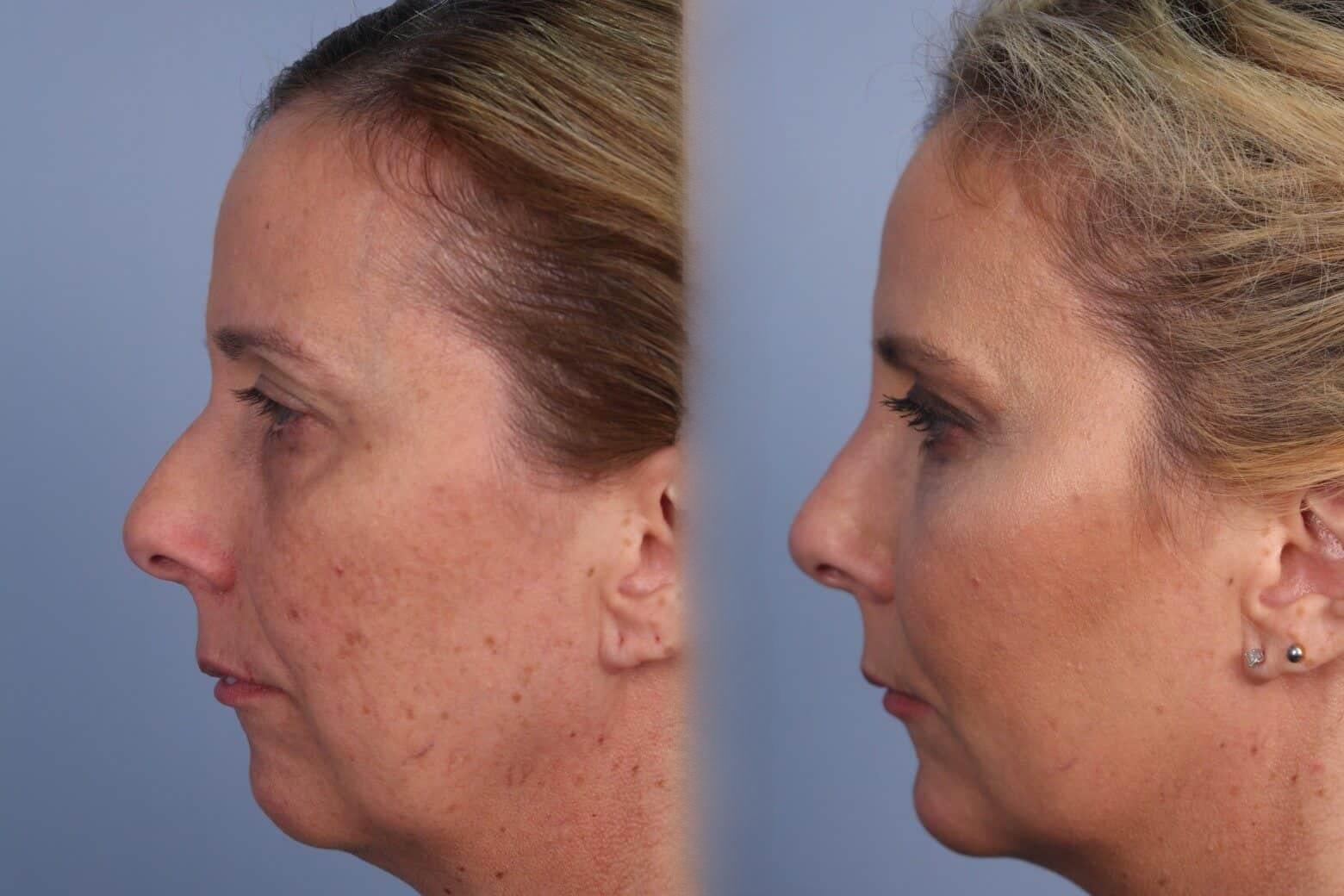 Fractional CO2 Laser Before and After Gallery – Photo 31