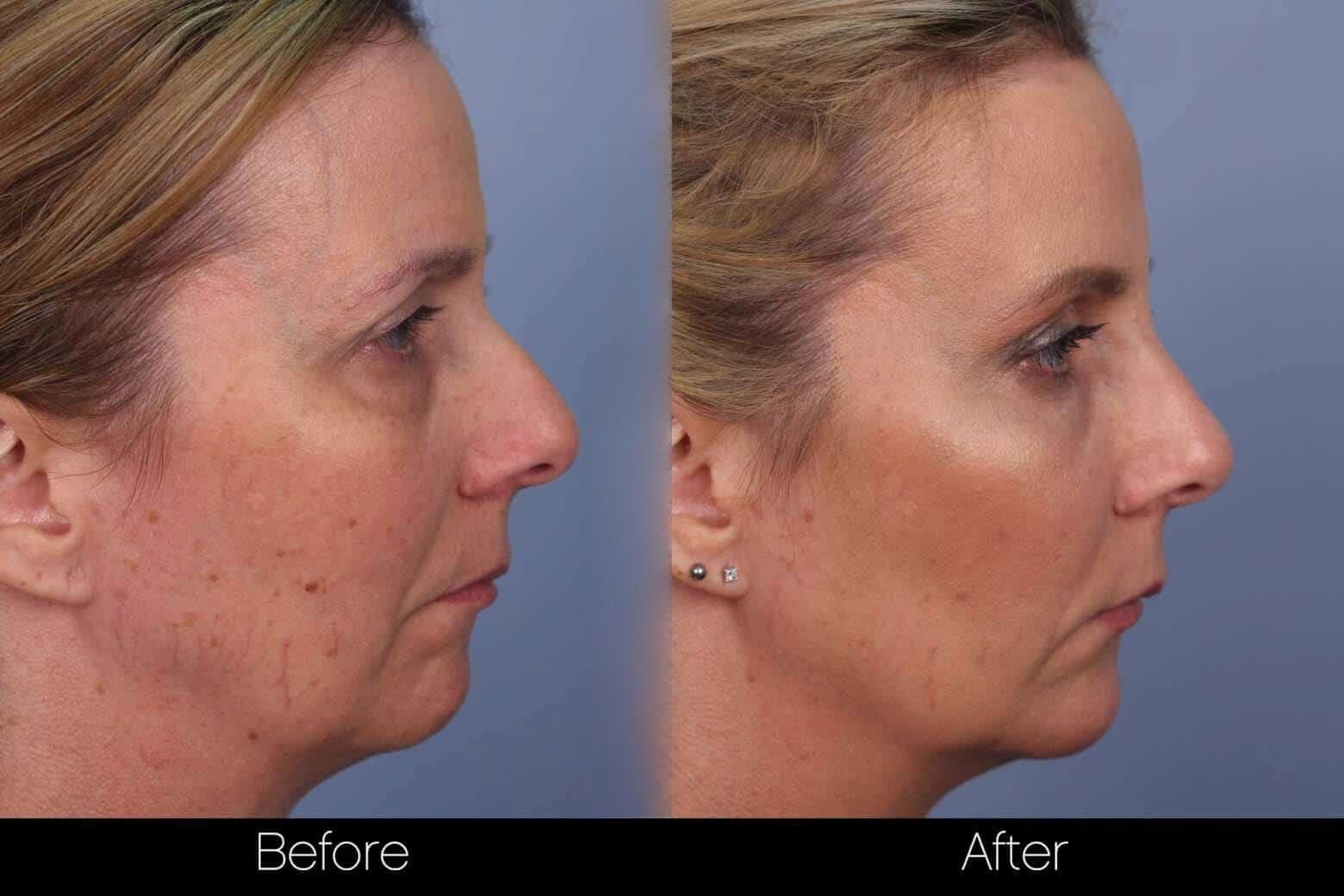 Fractional CO2 Laser Before and After Gallery – Photo 30