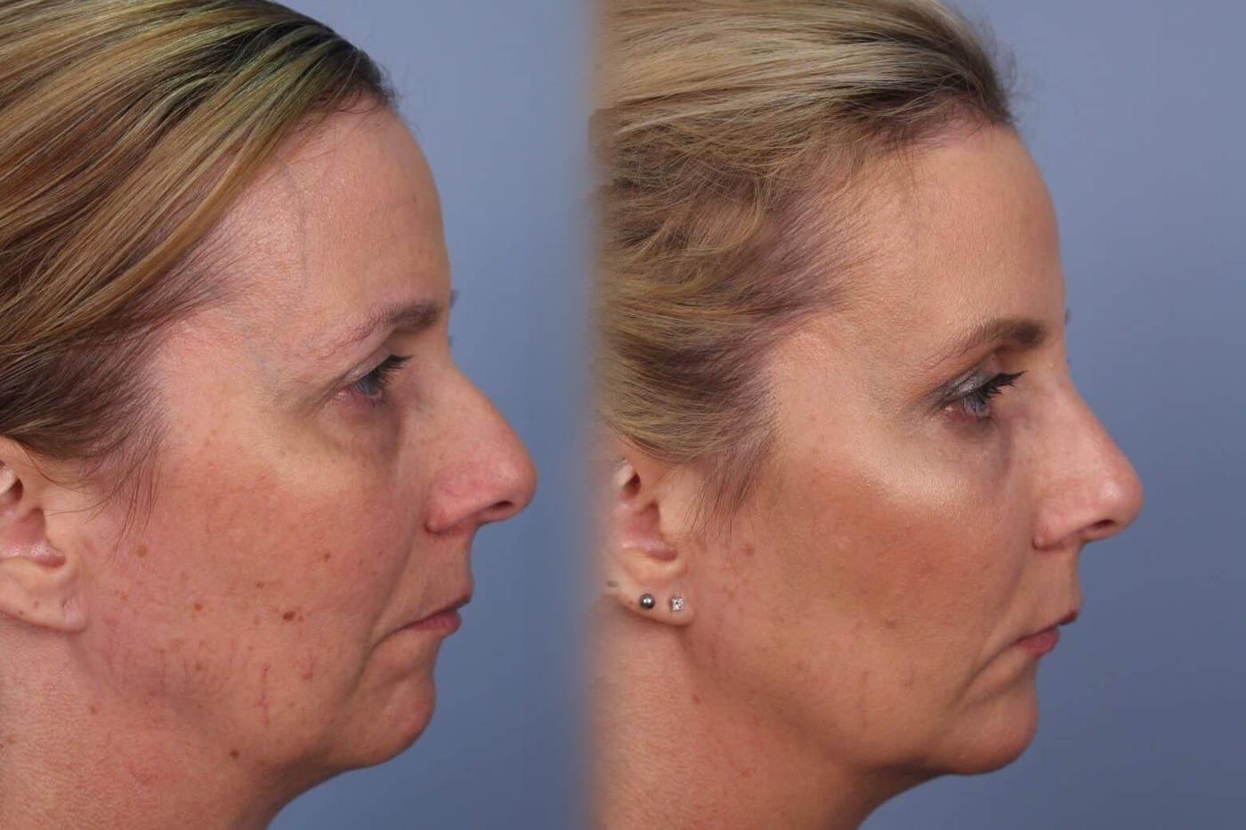 Fractional CO2 Laser Before and After Gallery – Photo 29