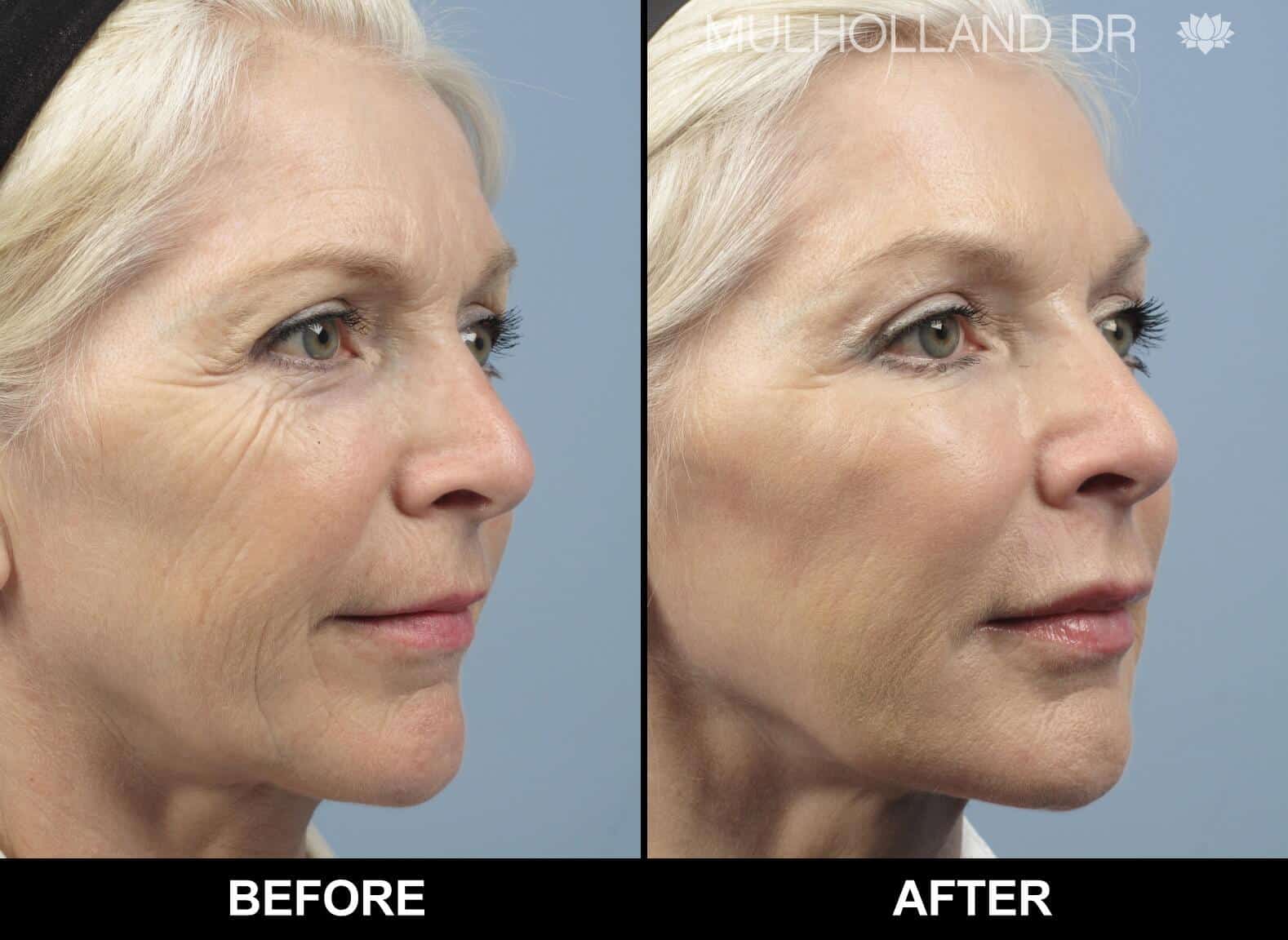 Dermal Fillers Before and After Gallery – Photo 101