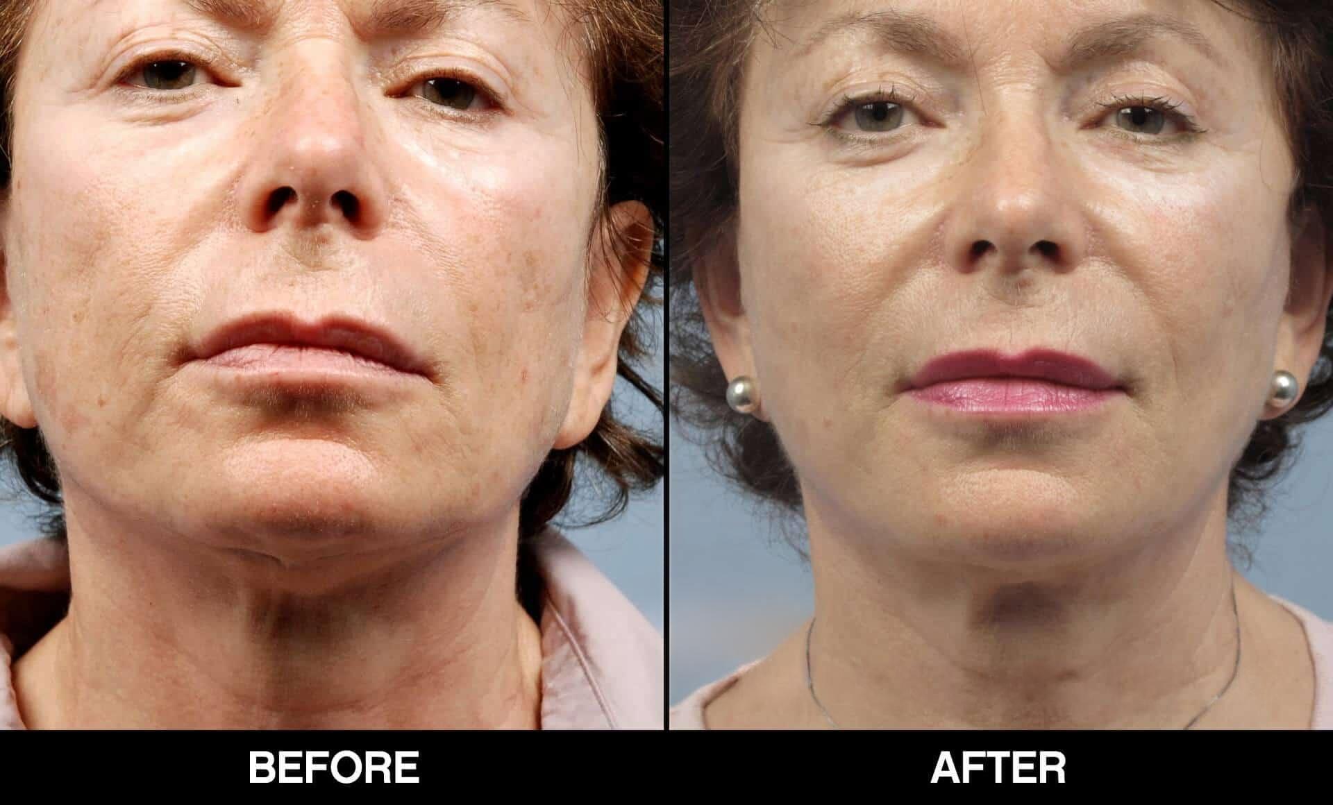 Fractional CO2 Laser Before and After Gallery – Photo 28
