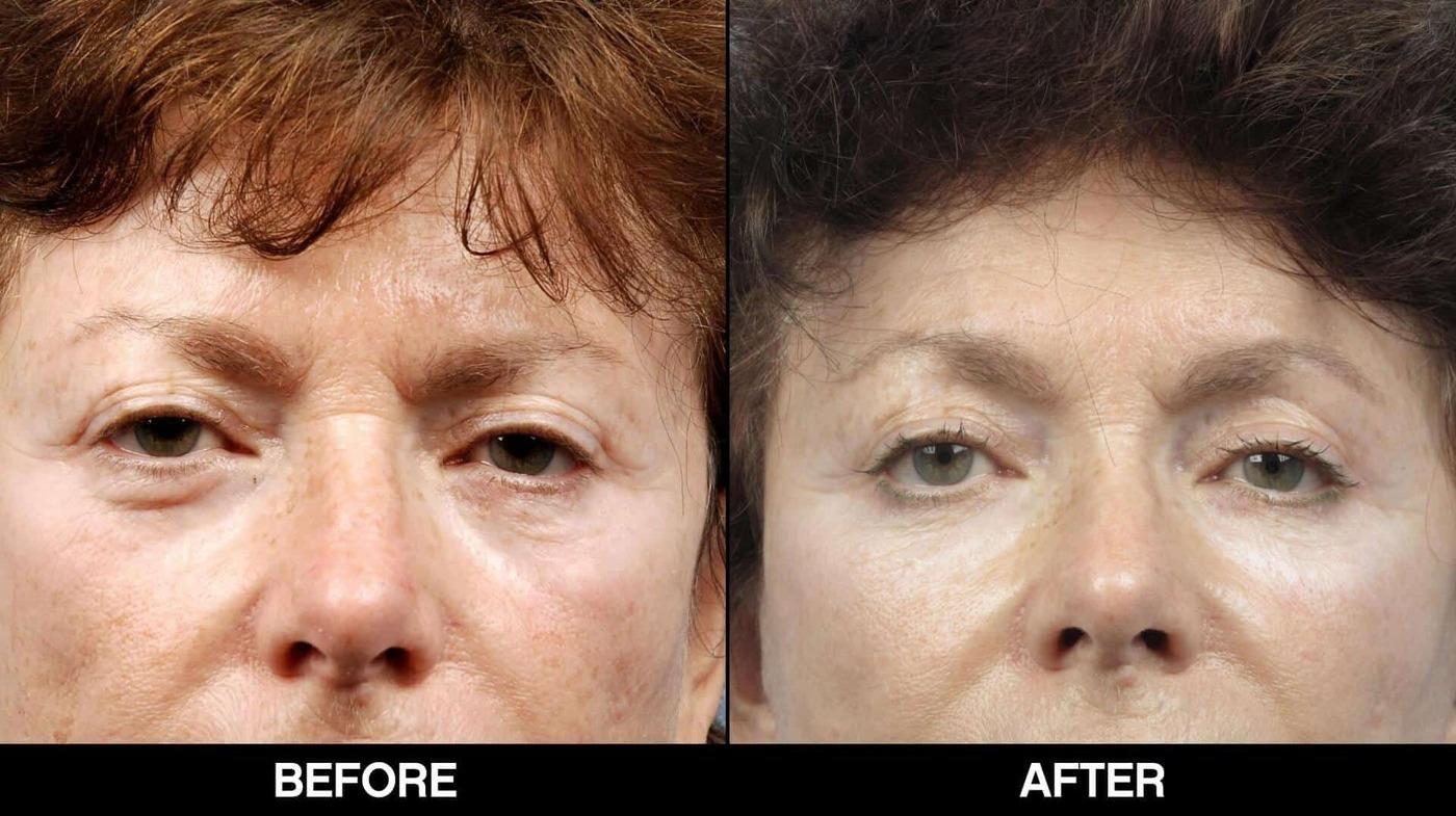 Fractional CO2 Laser Before and After Gallery – Photo 27