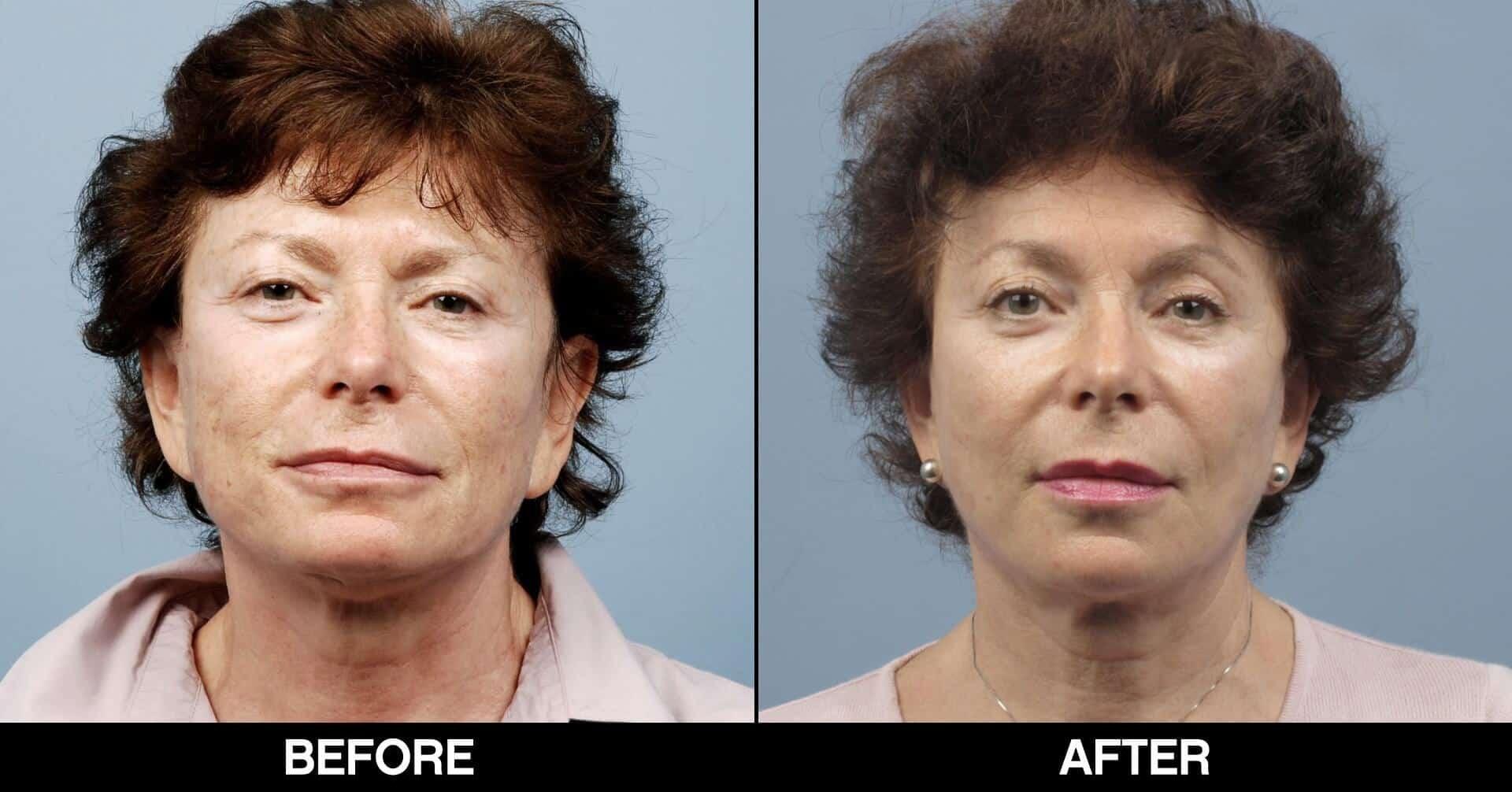 Fractional CO2 Laser Before and After Gallery – Photo 26