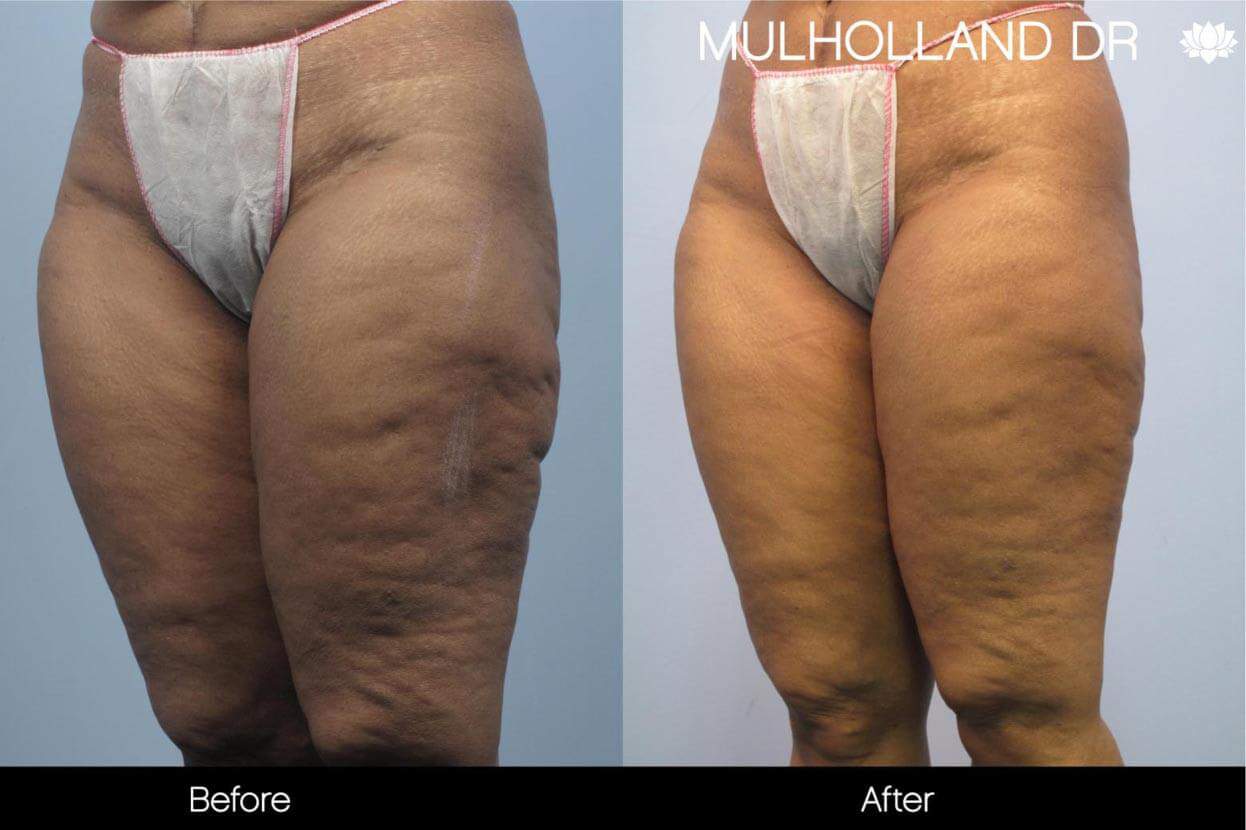 Cellulite Reduction Before and After Gallery – Photo 45