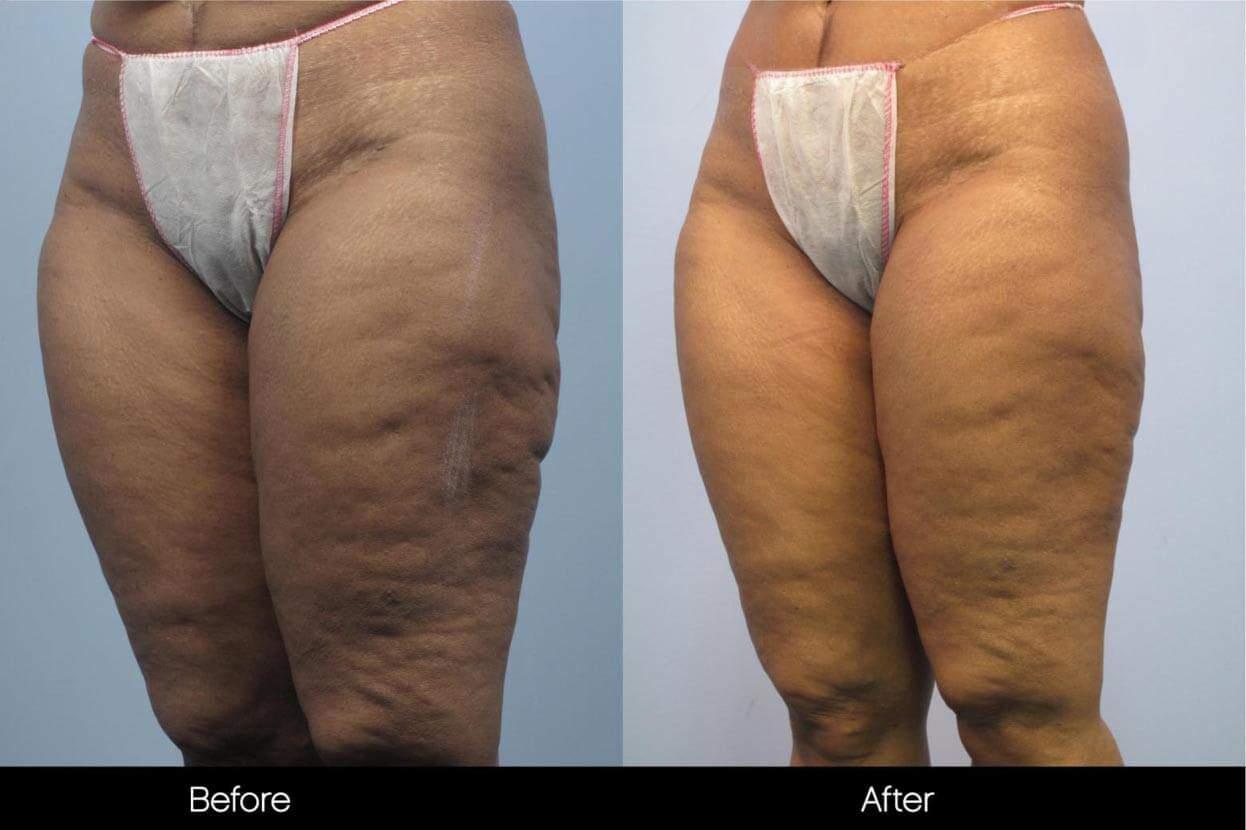 Cellulite Reduction Before and After Gallery – Photo 45