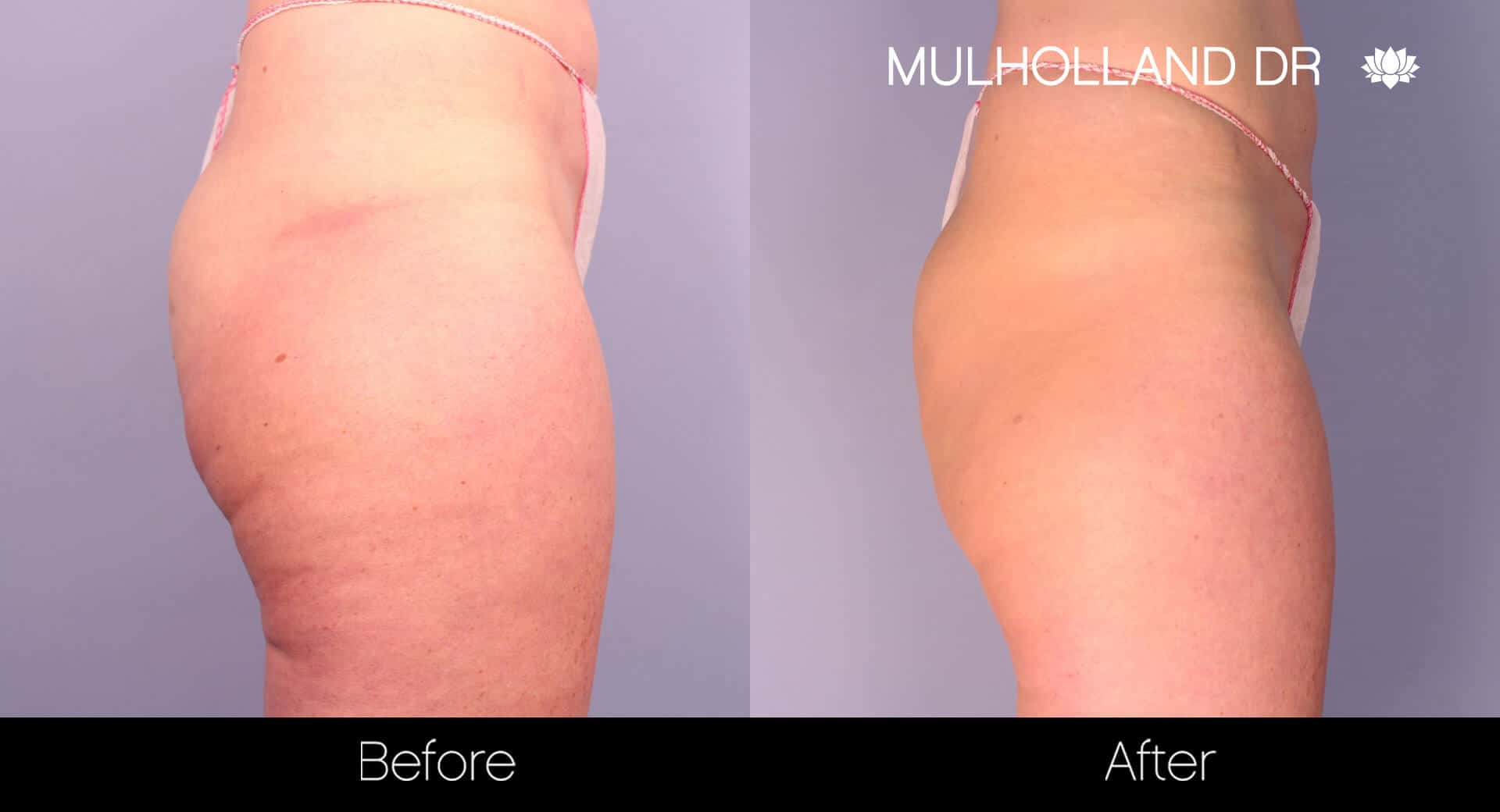 Cellfina Cellulite Treatment - Before and After Gallery – Photo 5
