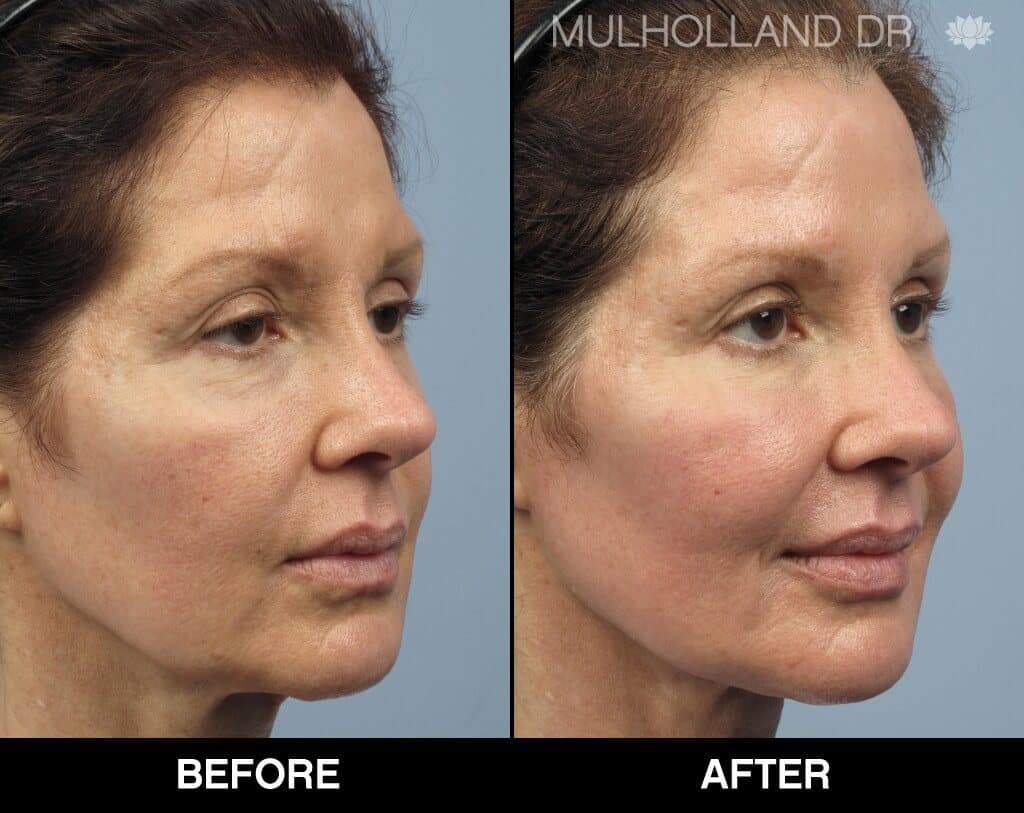 Dermal Fillers Before and After Gallery – Photo 140