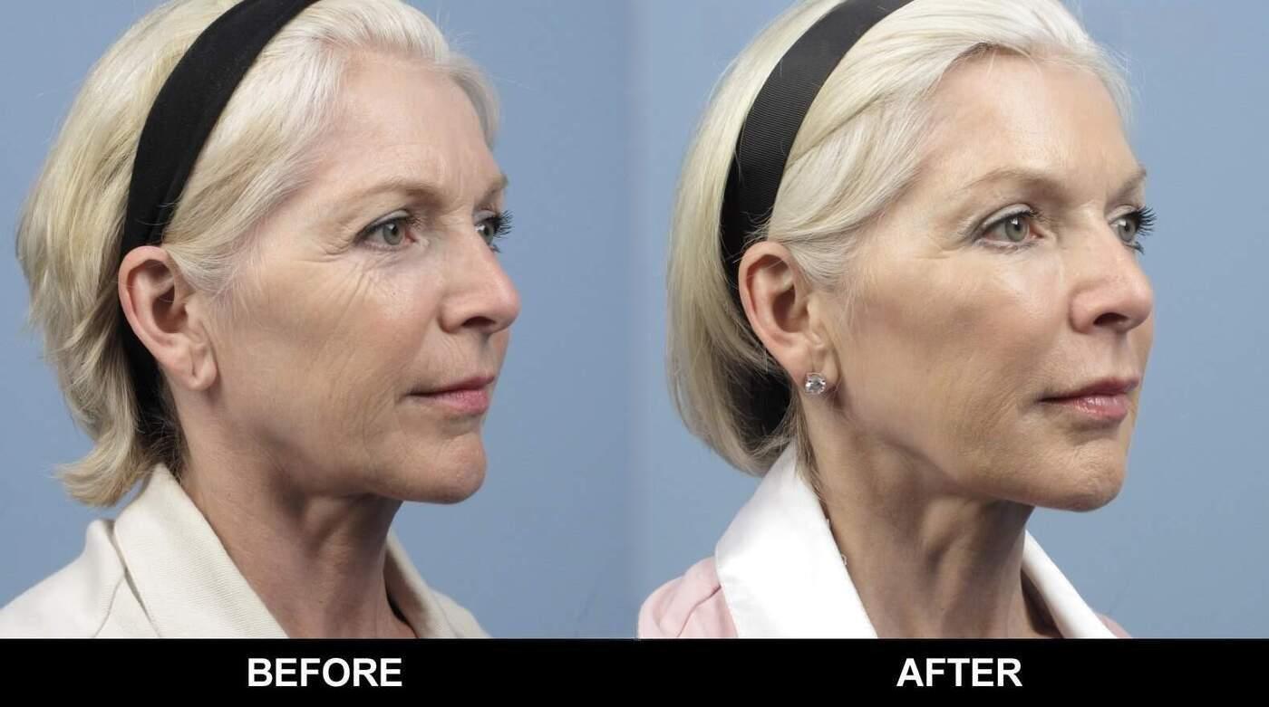 Dermal Fillers Before and After Gallery – Photo 96