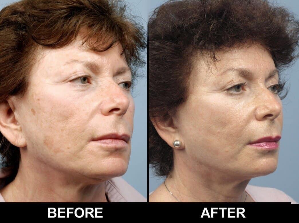 Fractional CO2 Laser Before and After Gallery – Photo 22