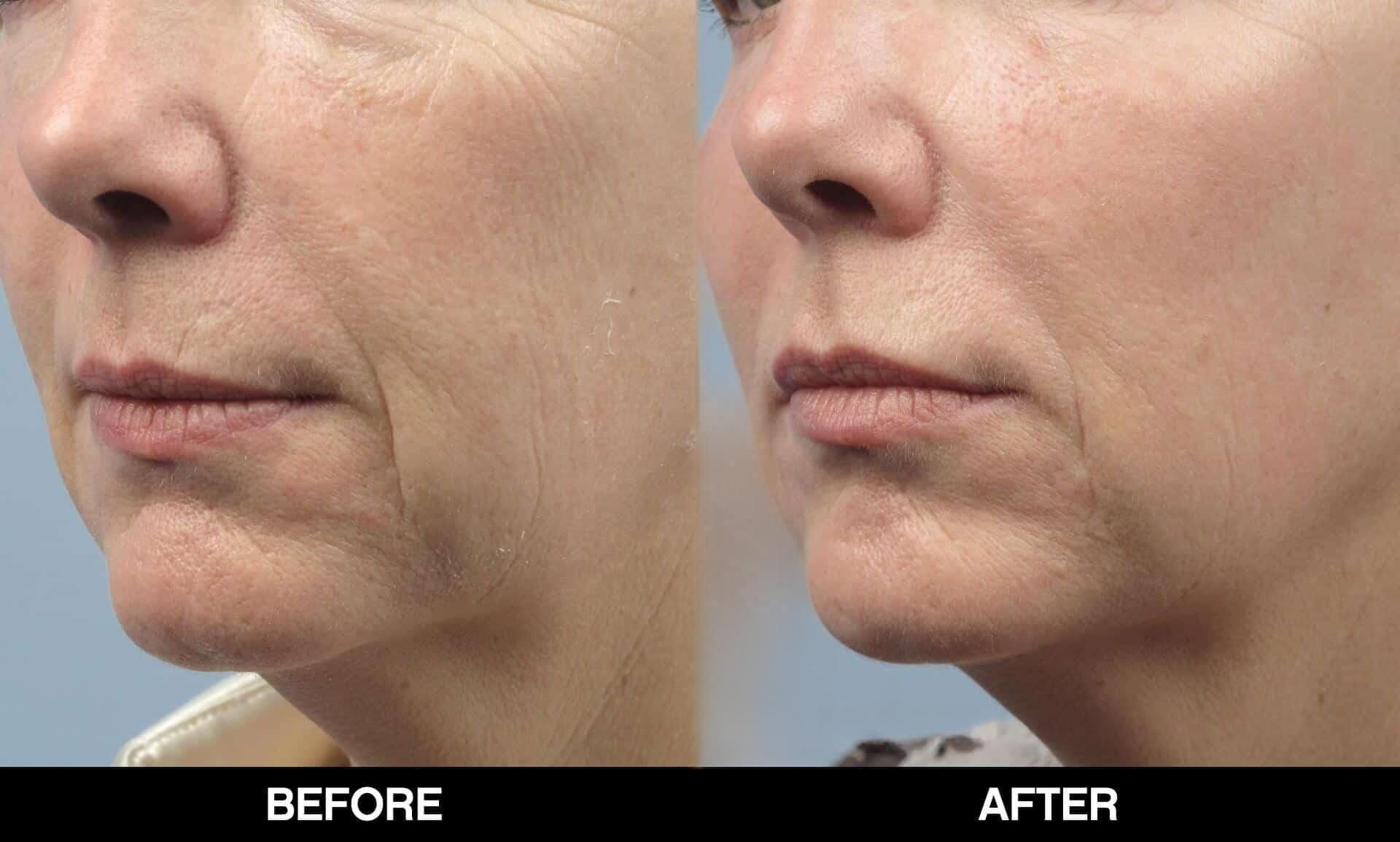 Fractional CO2 Laser Before and After Gallery – Photo 21