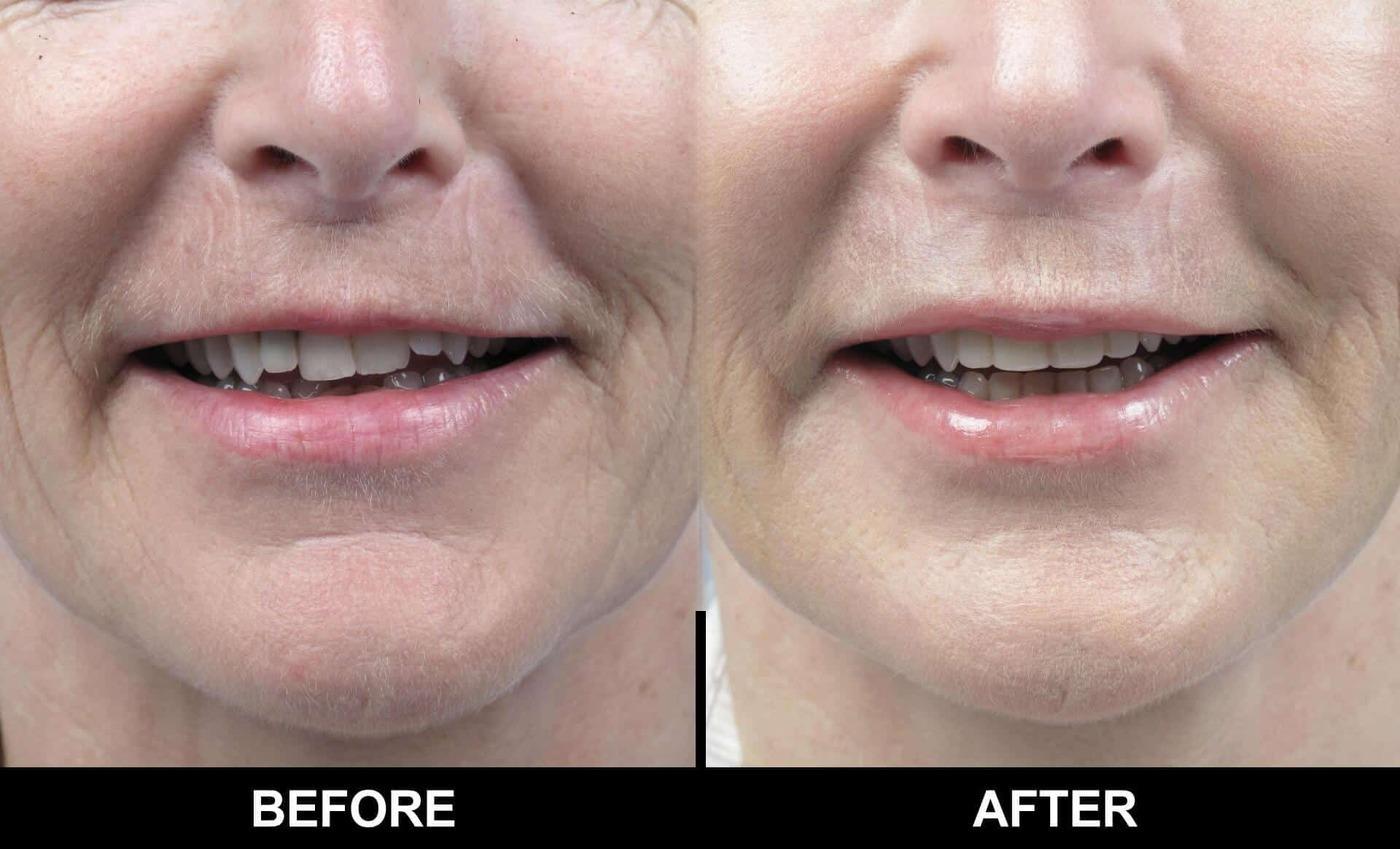 Dermal Fillers Before and After Gallery – Photo 93