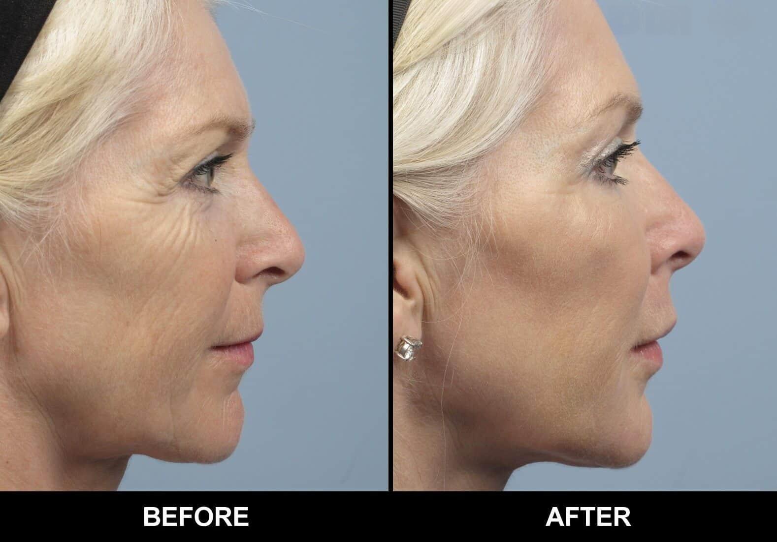Dermal Fillers Before and After Gallery – Photo 91