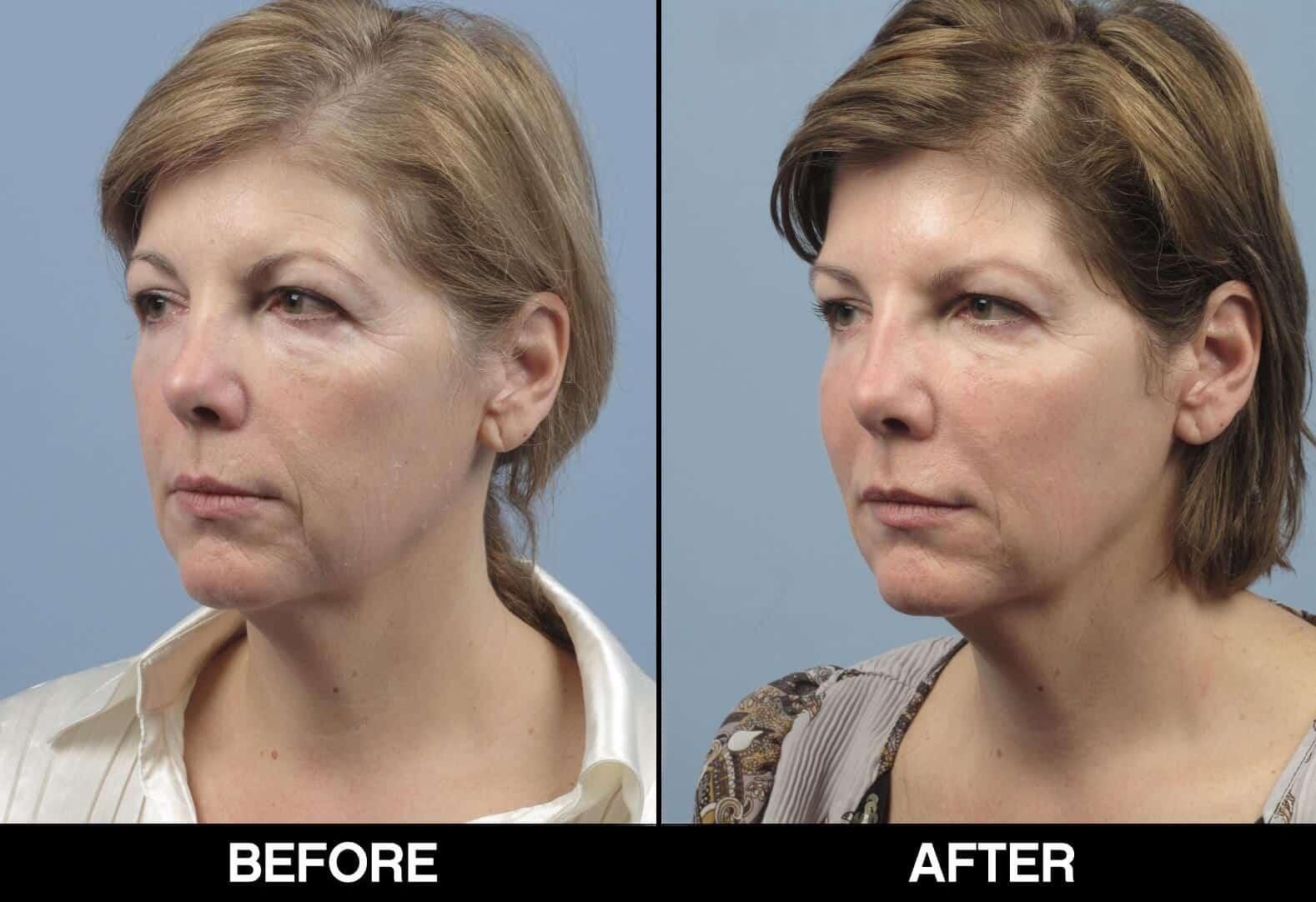 Fractional CO2 Laser Before and After Gallery – Photo 19