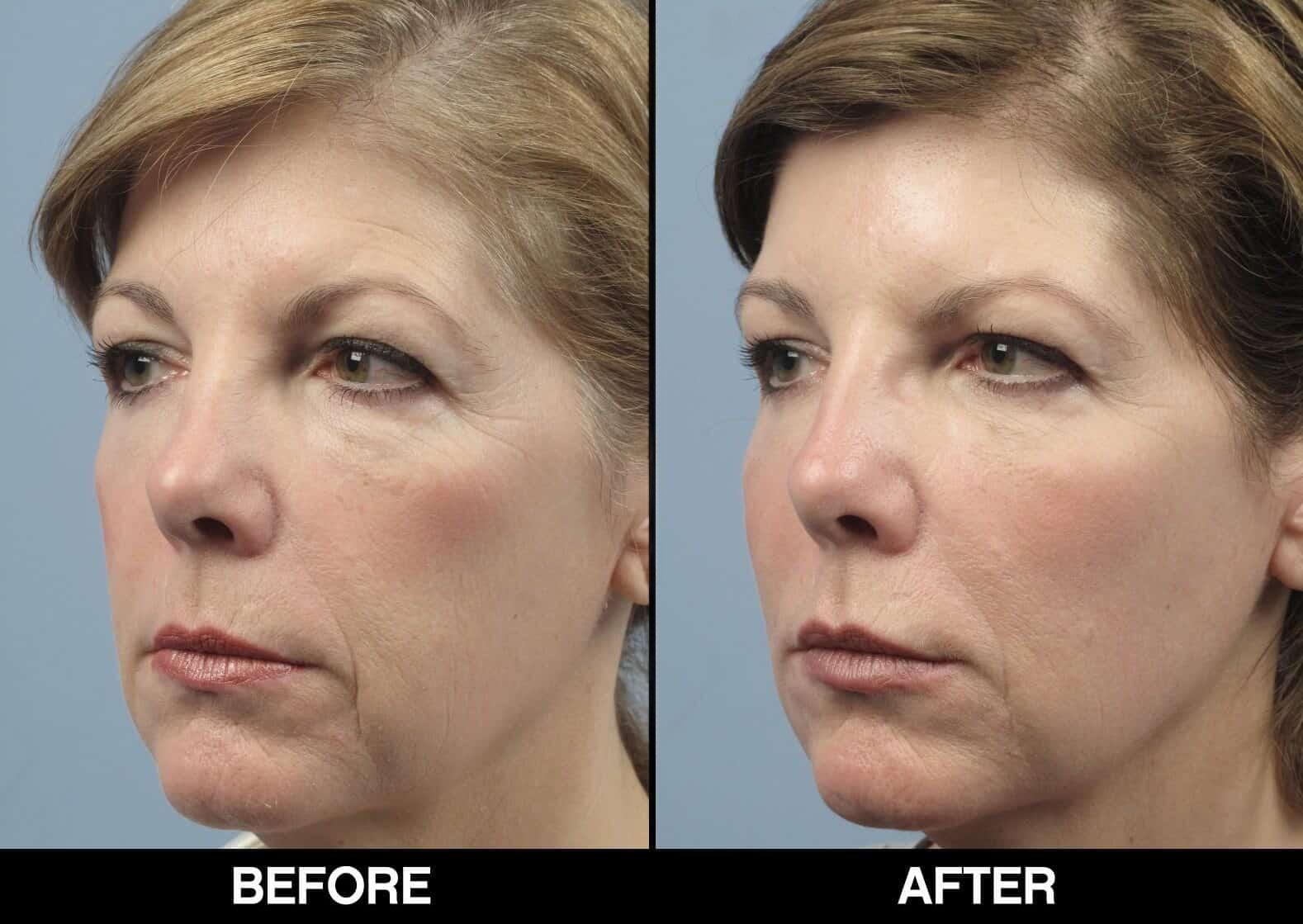 Fractional CO2 Laser Before and After Gallery – Photo 18