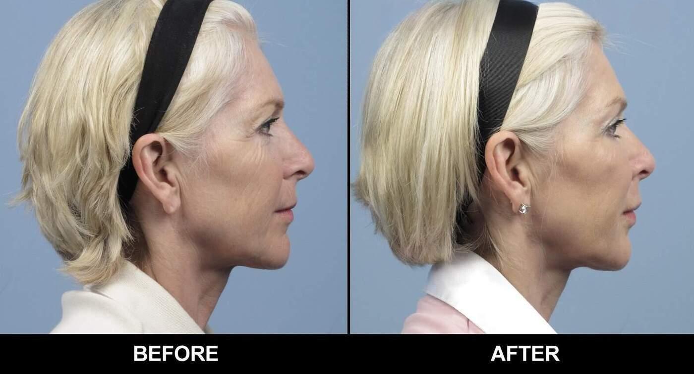 Dermal Fillers Before and After Gallery – Photo 90