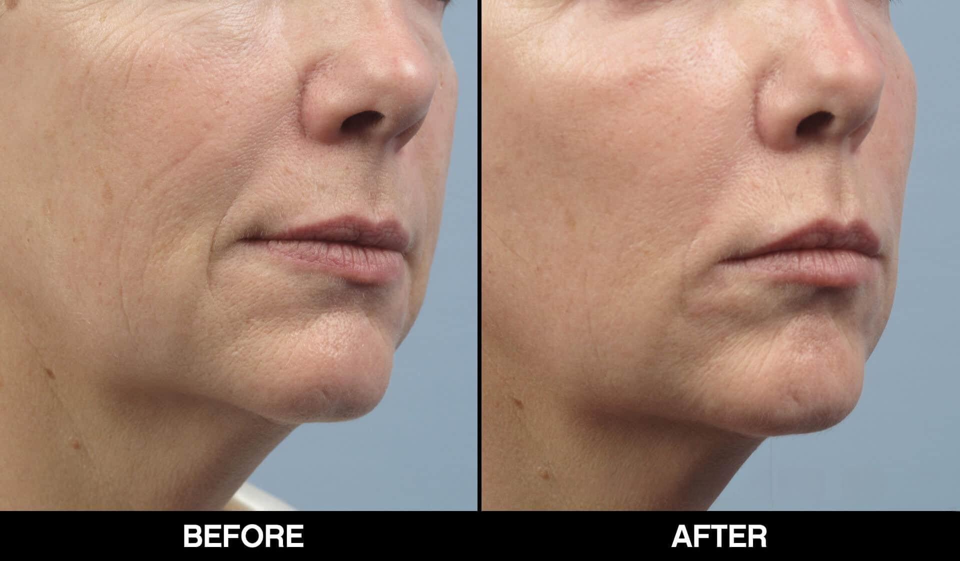 Fractional CO2 Laser Before and After Gallery – Photo 17