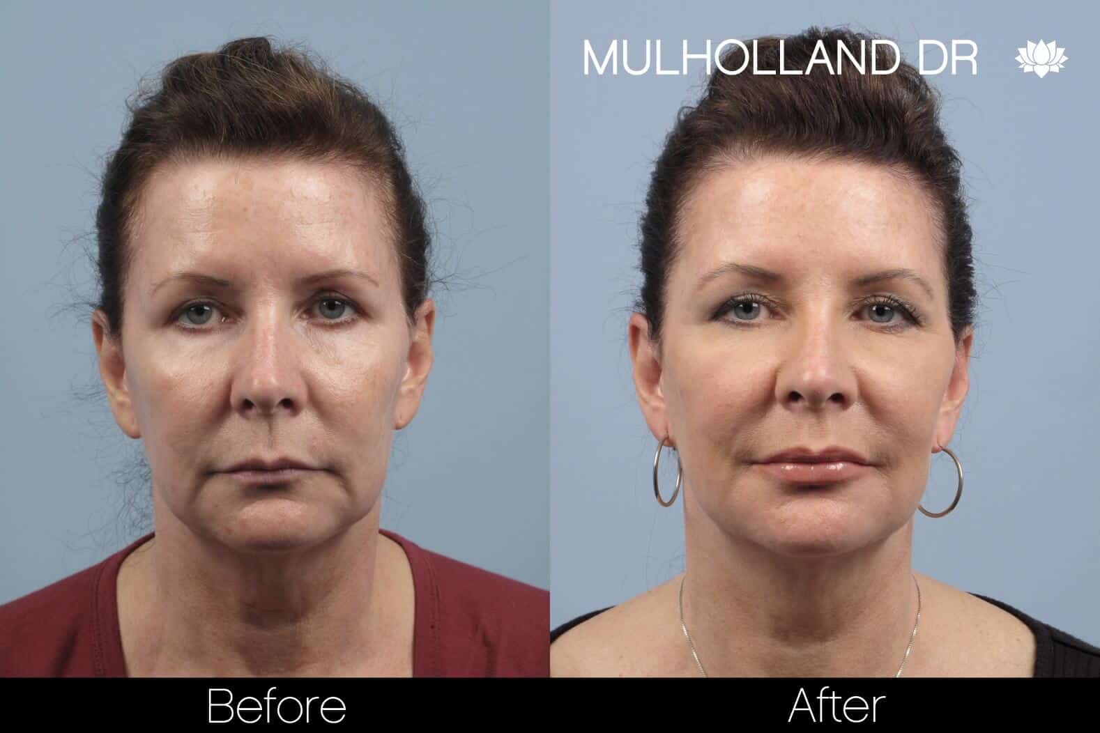Dermal Fillers Before and After Gallery – Photo 87