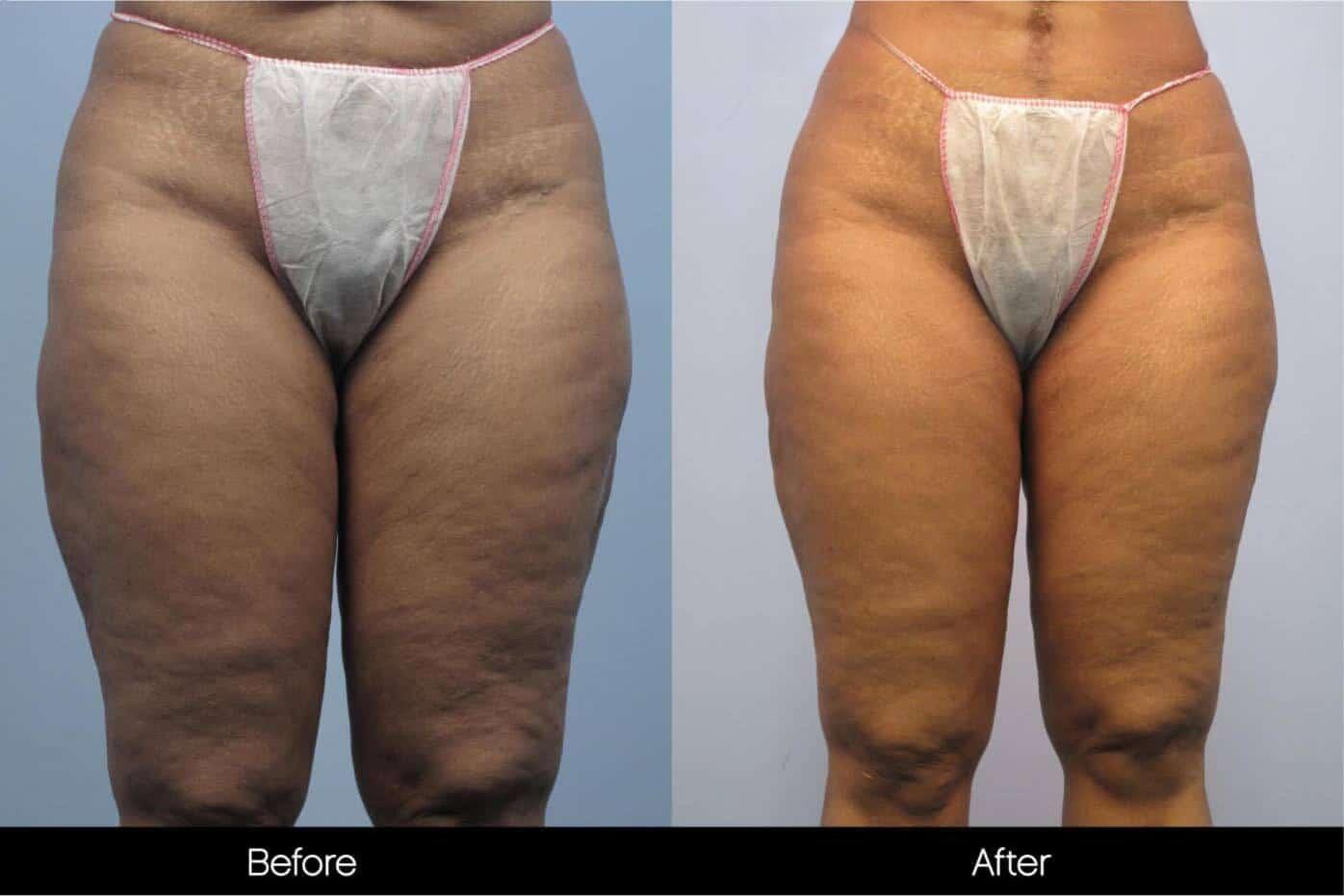 Cellulite Reduction Before and After Gallery – Photo 44