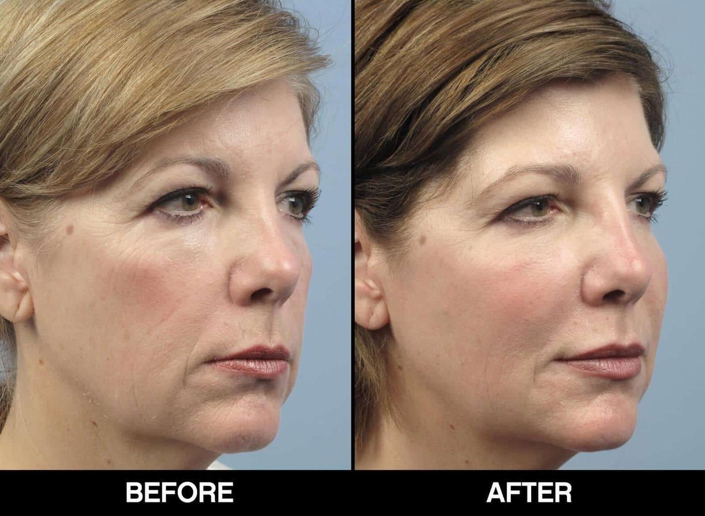 Fractional CO2 Laser Before and After Gallery – Photo 14