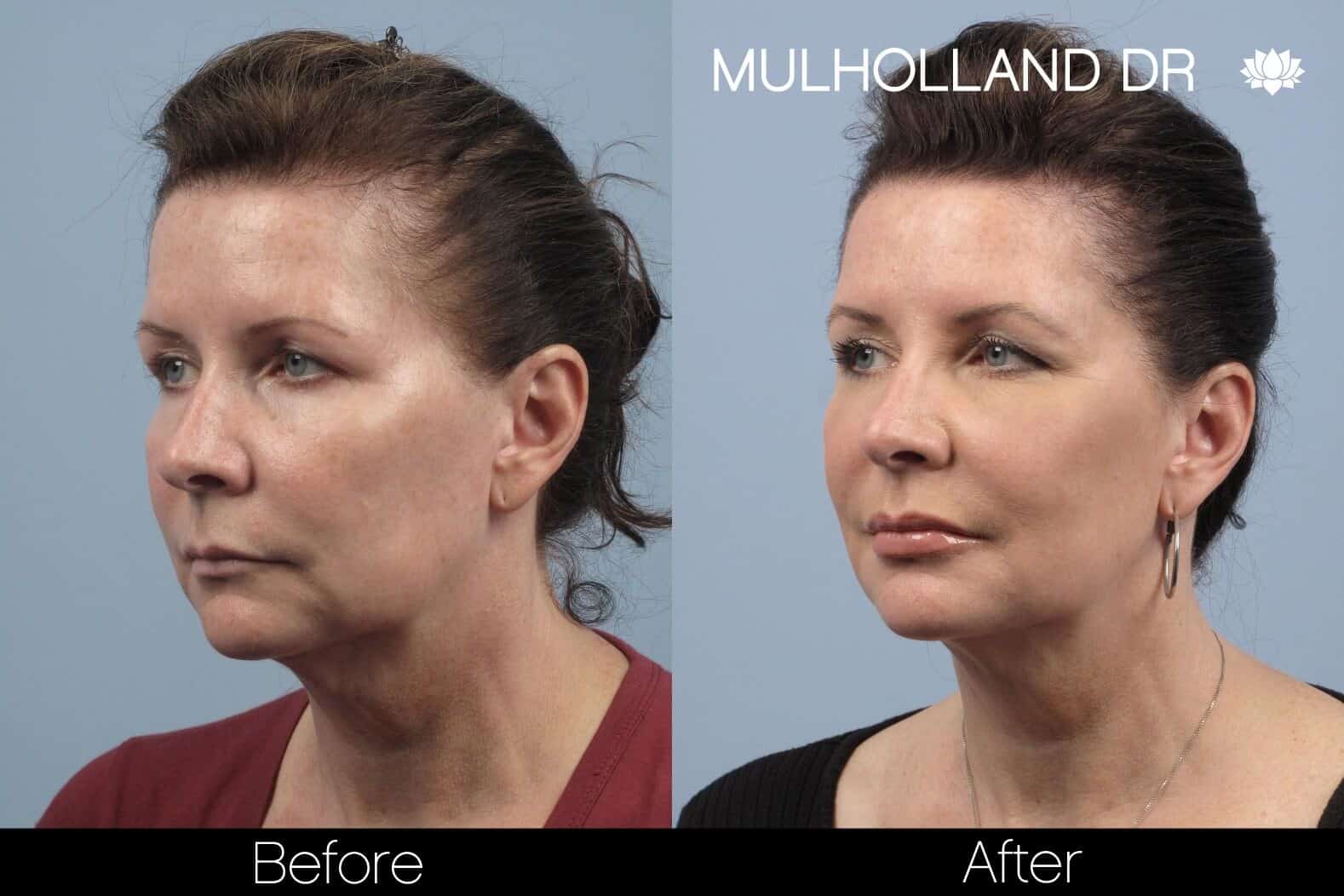 Dermal Fillers Before and After Gallery – Photo 86