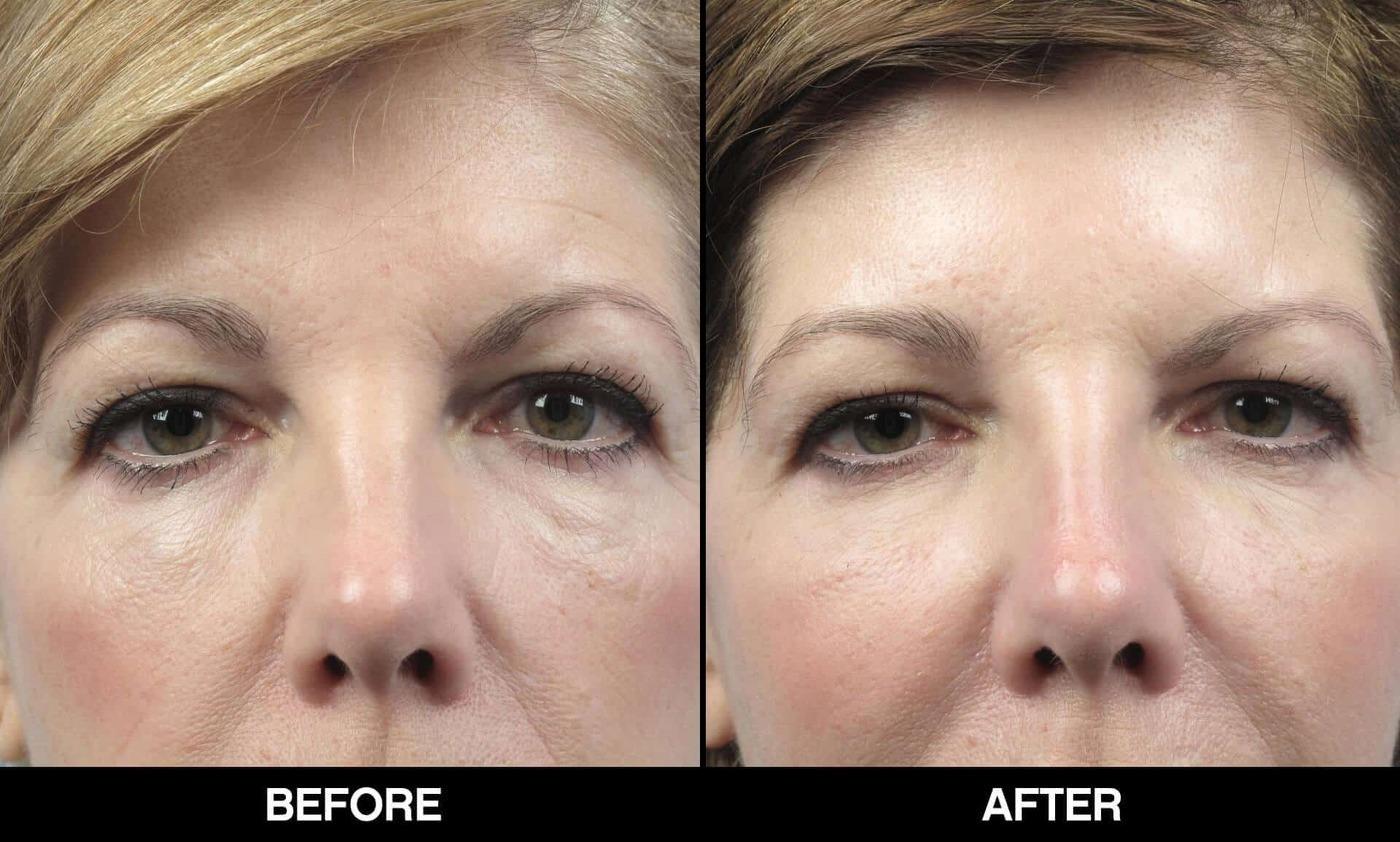 Fractional CO2 Laser Before and After Gallery – Photo 13