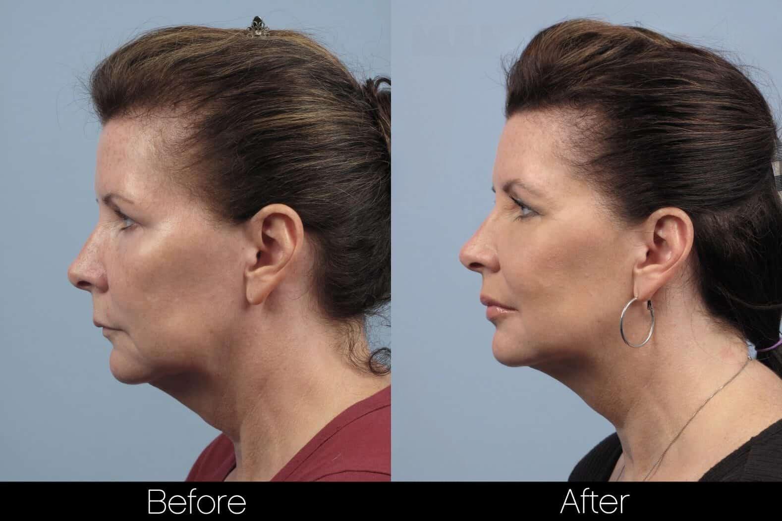 Dermal Fillers Before and After Gallery – Photo 85