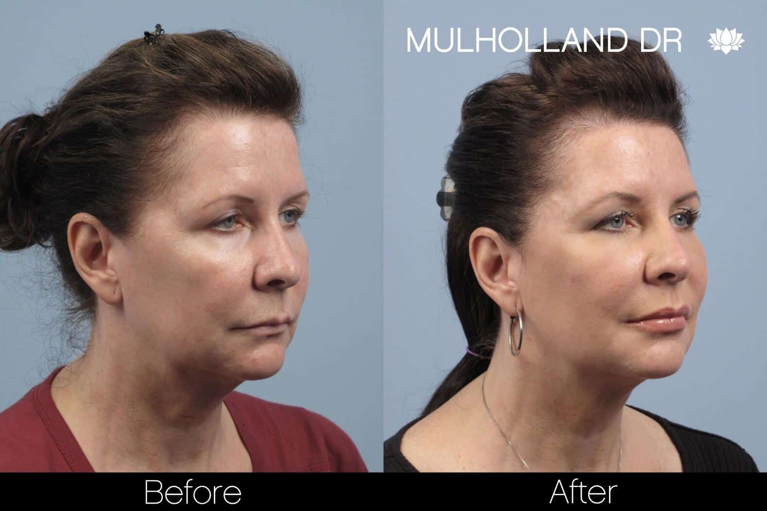 Dermal Fillers Before and After Gallery – Photo 84