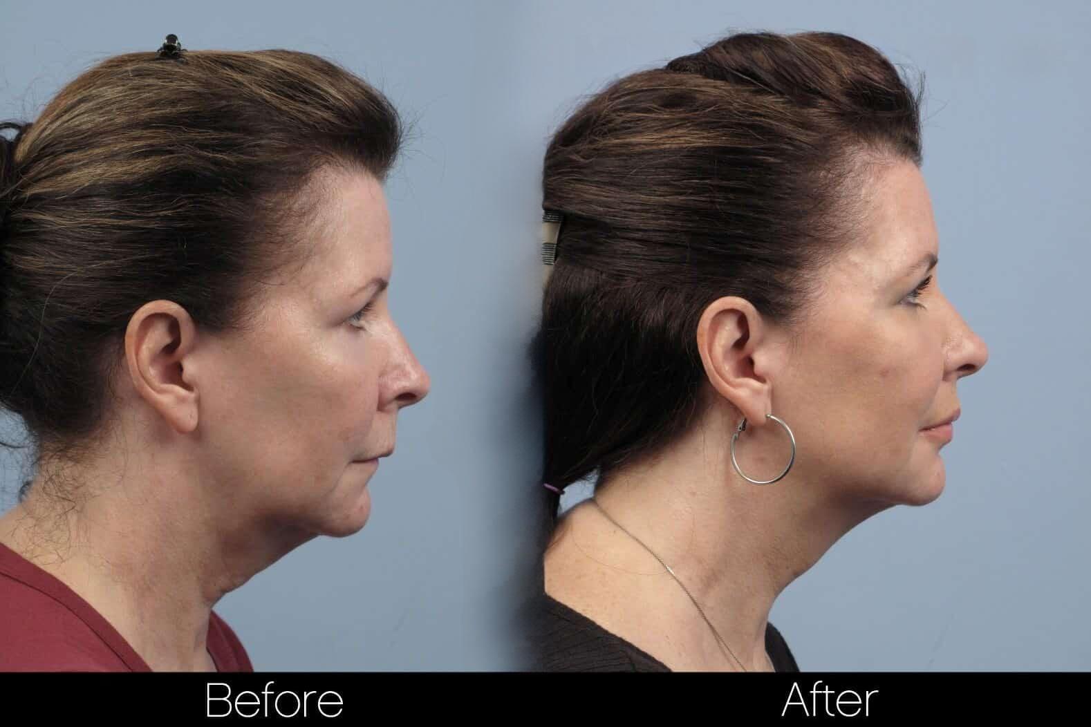 Dermal Fillers Before and After Gallery – Photo 83