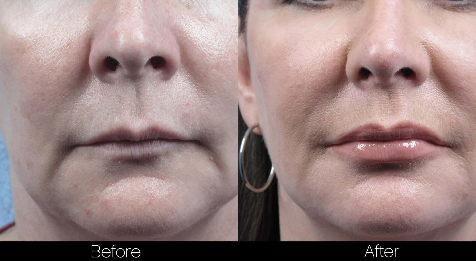 Dermal Fillers Before and After Gallery – Photo 80