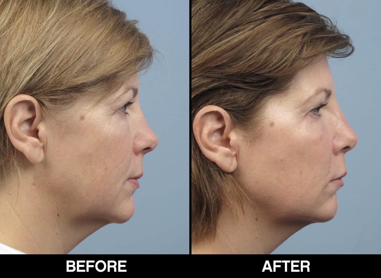 Fractional CO2 Laser Before and After Gallery – Photo 6