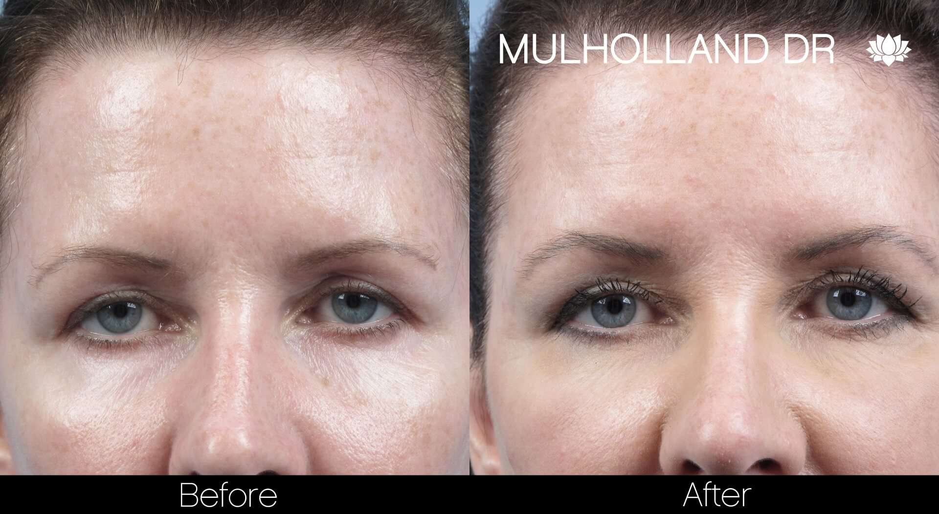 Dermal Fillers Before and After Gallery – Photo 77