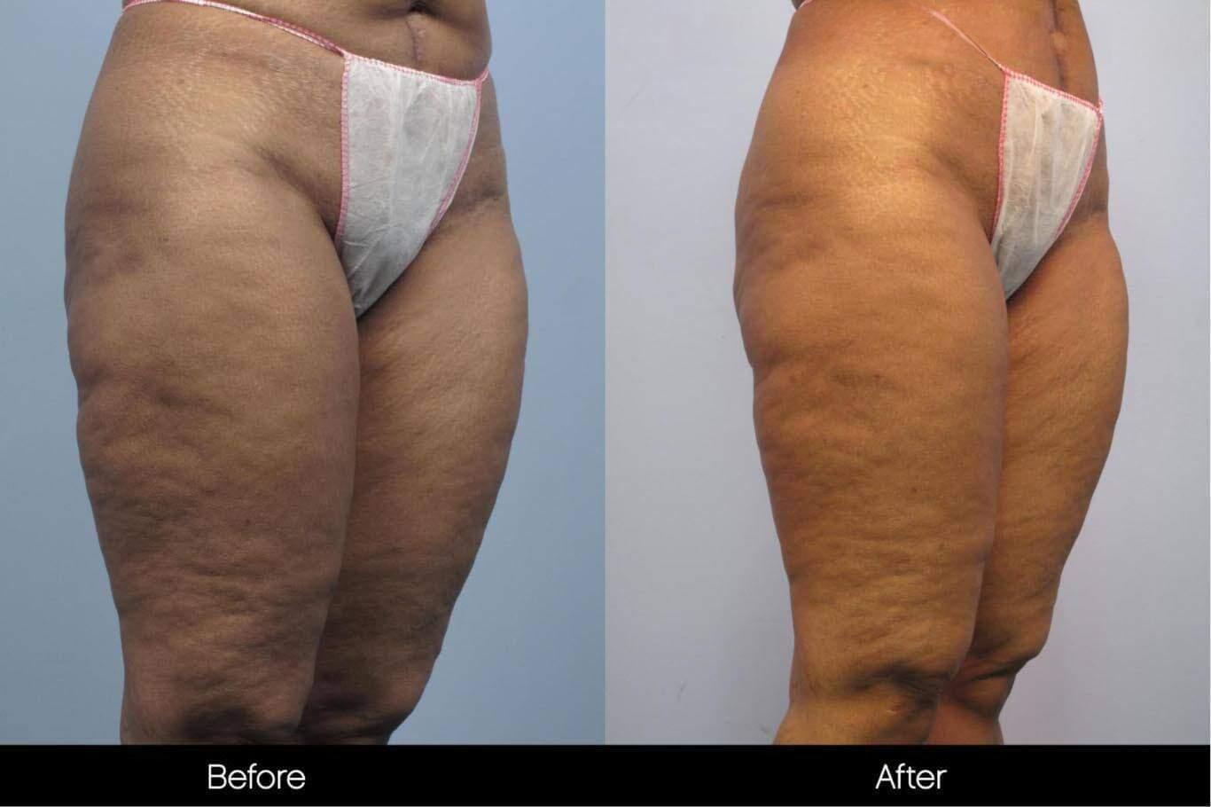 Cellulite Reduction Before and After Gallery – Photo 43