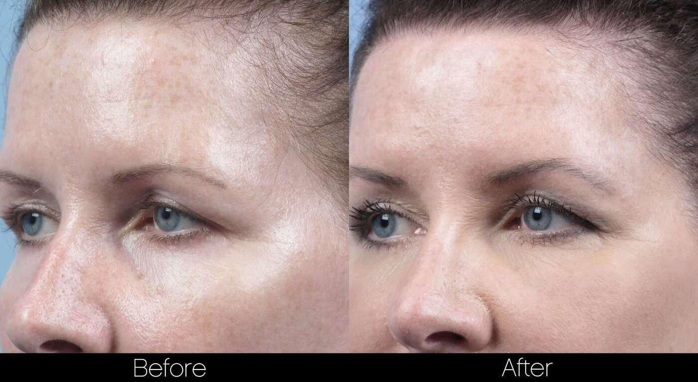 Dermal Fillers Before and After Gallery – Photo 76