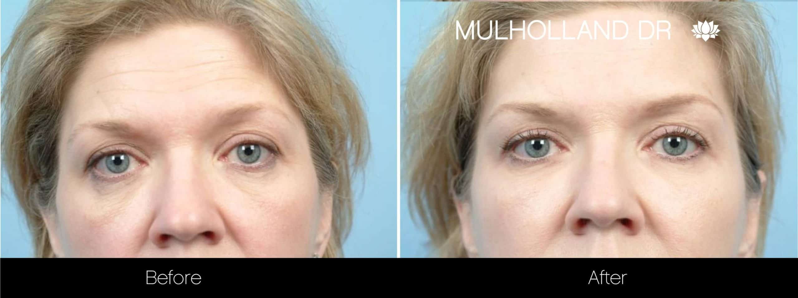 Fractional CO2 Laser Before and After Gallery – Photo 3
