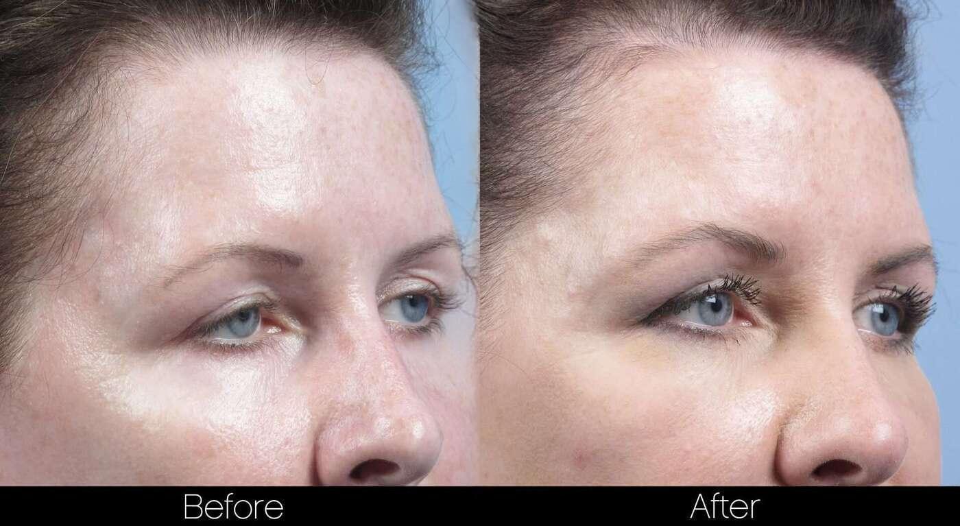 Dermal Fillers Before and After Gallery – Photo 75