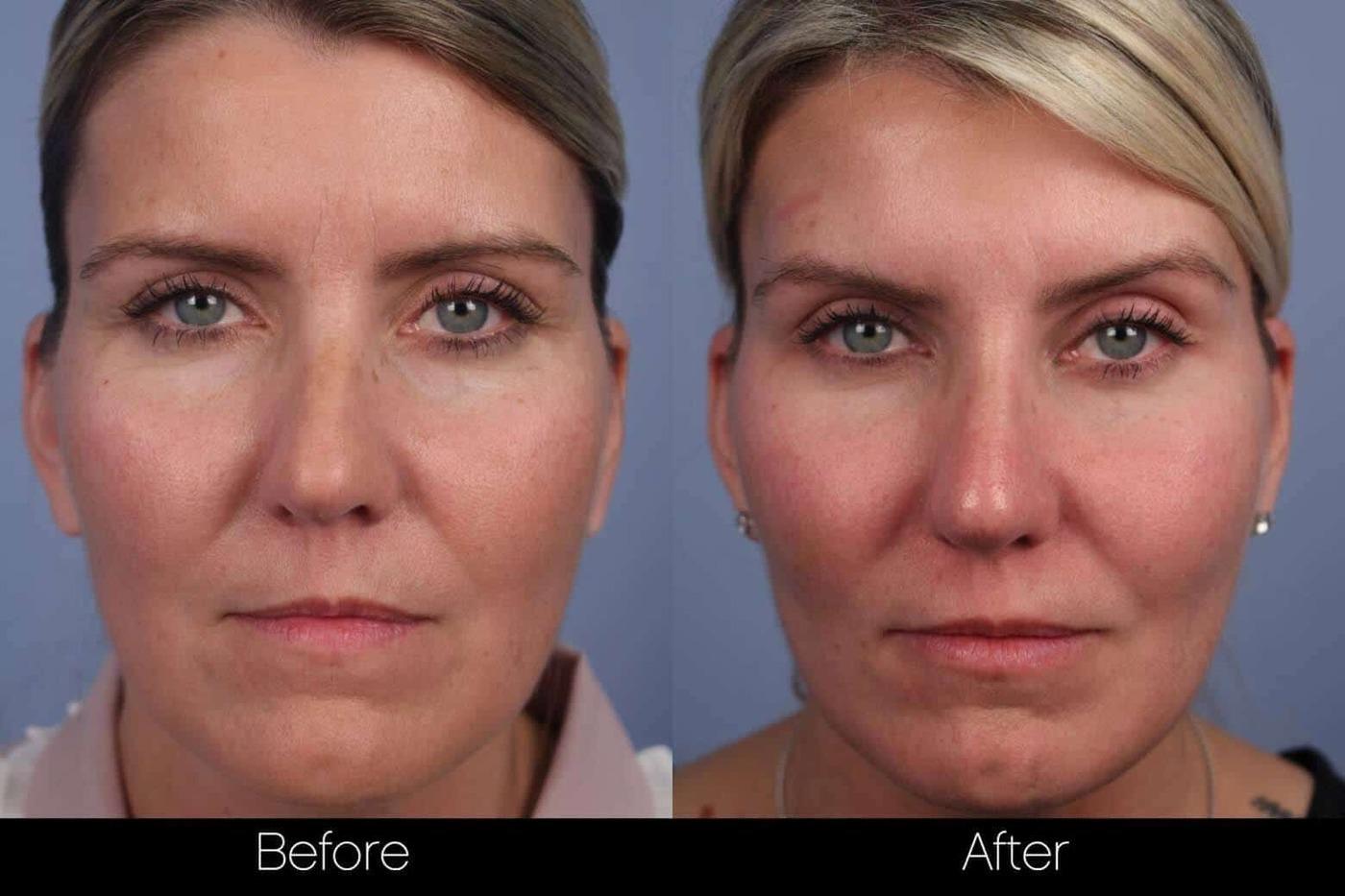 Dermal Fillers Before and After Gallery – Photo 74
