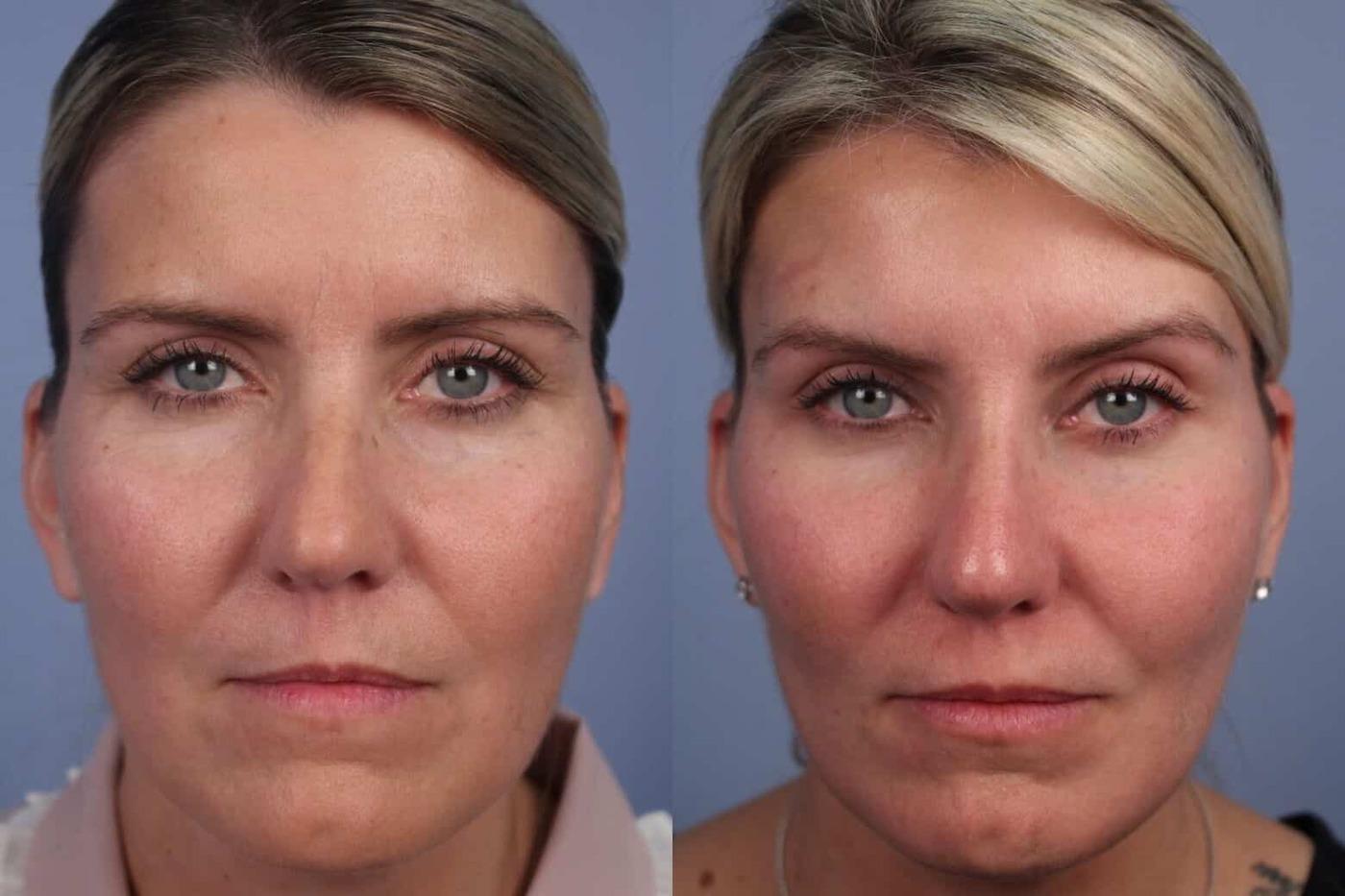 Dermal Fillers Before and After Gallery – Photo 73