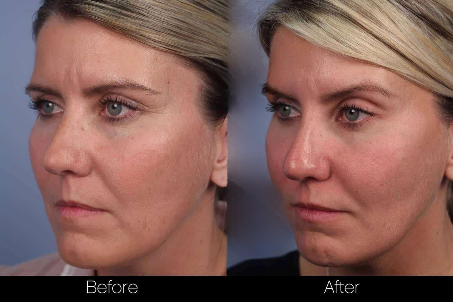 Dermal Fillers Before and After Gallery – Photo 72