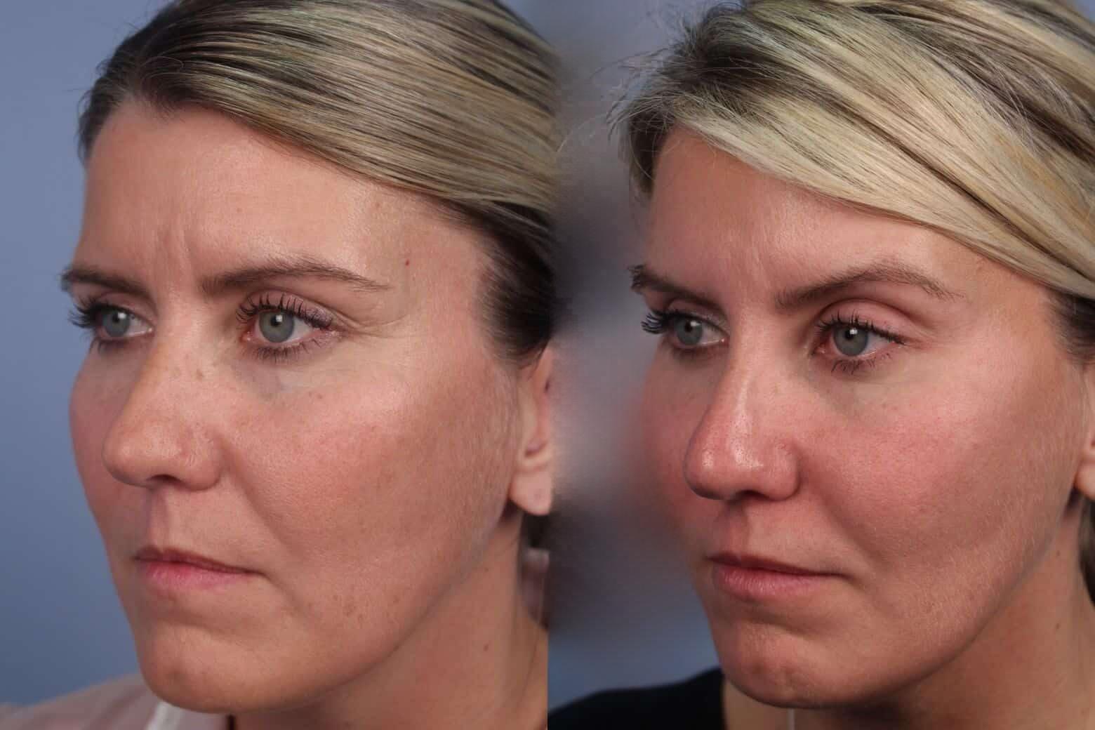 Dermal Fillers Before and After Gallery – Photo 71
