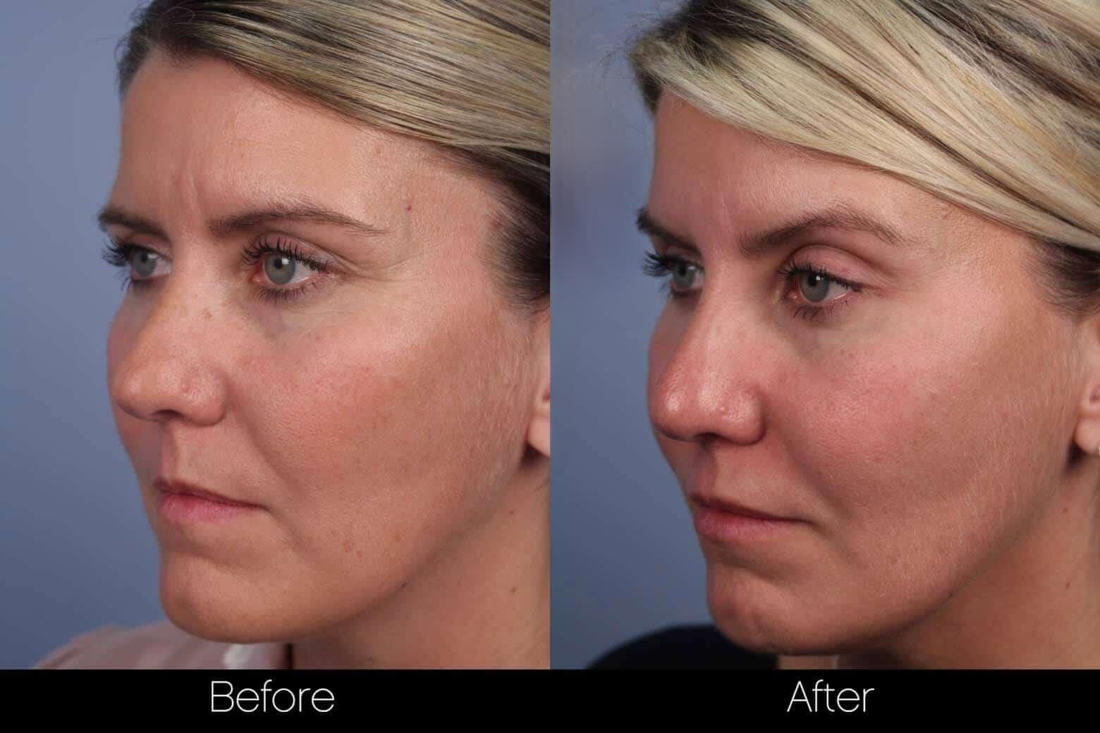 Dermal Fillers Before and After Gallery – Photo 70