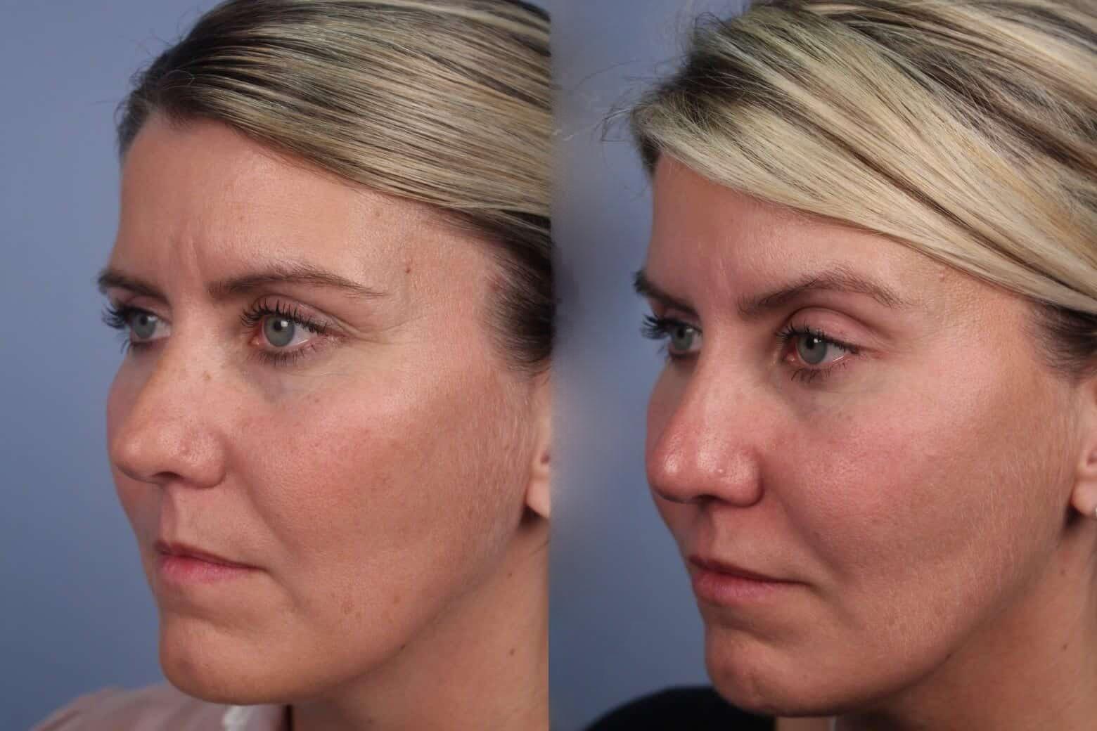 Dermal Fillers Before and After Gallery – Photo 69