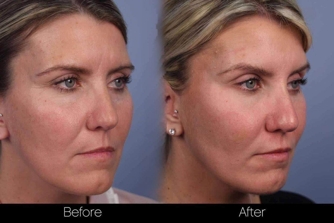 Dermal Fillers Before and After Gallery – Photo 68