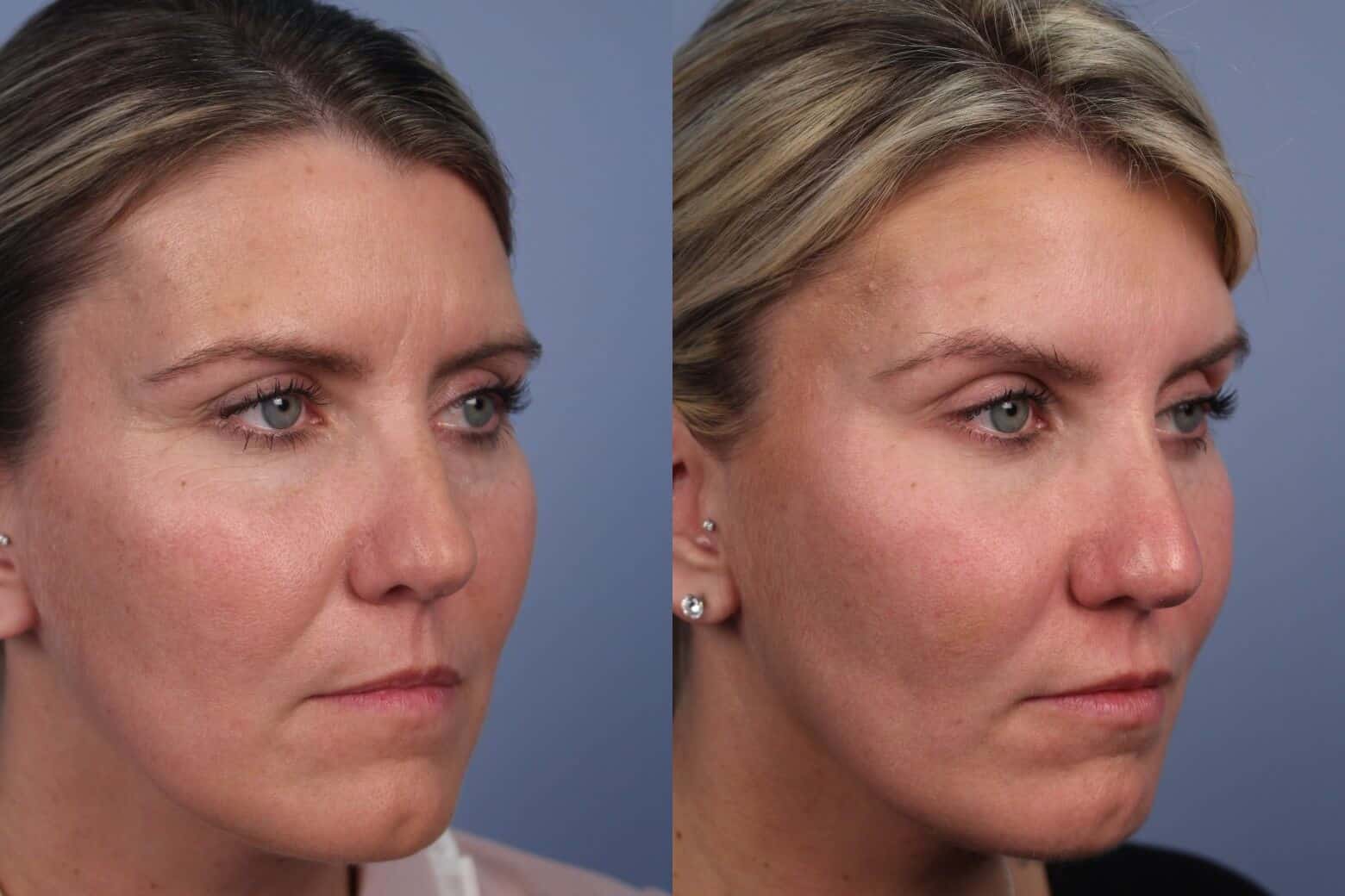 Dermal Fillers Before and After Gallery – Photo 67