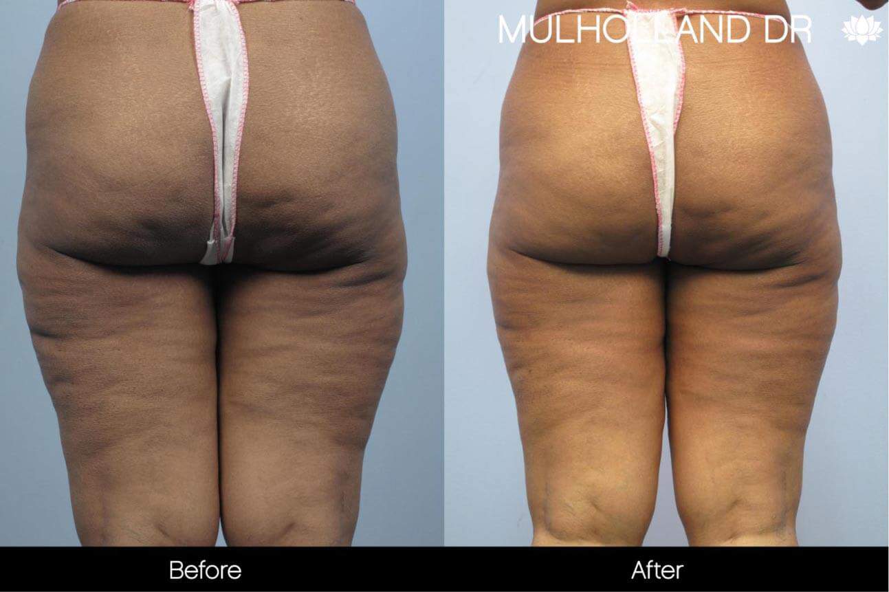 Cellulite Reduction Before and After Gallery – Photo 42