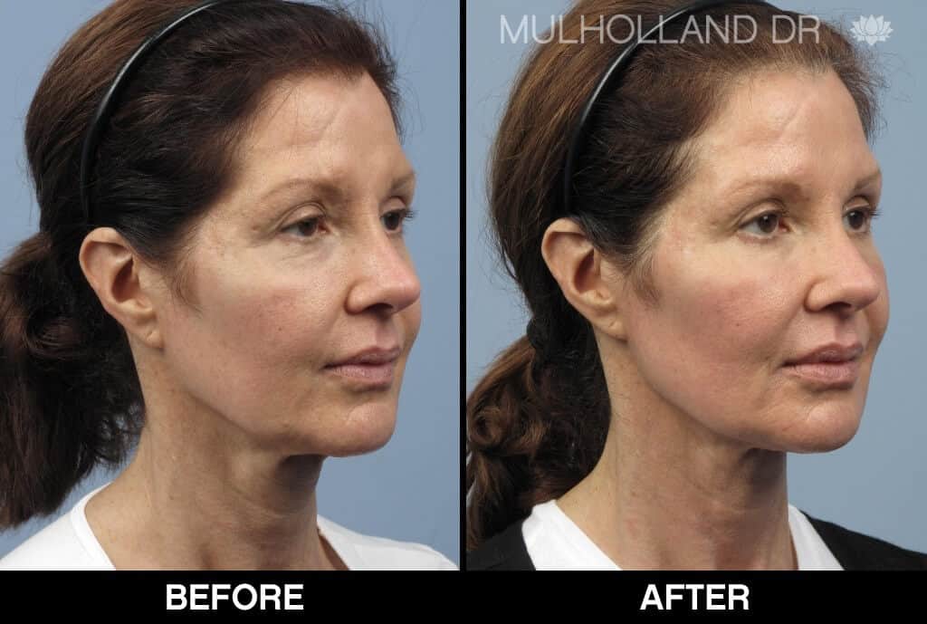 Dermal Fillers Before and After Gallery – Photo 137